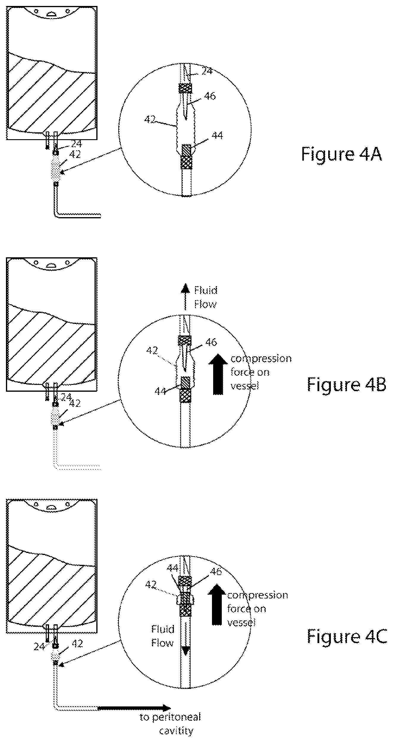 Patent US11779519 Figure 4 – Systems and methods for delivery of peritoneal dialysis (PD) solutions with integrated inter-chamber diffuser