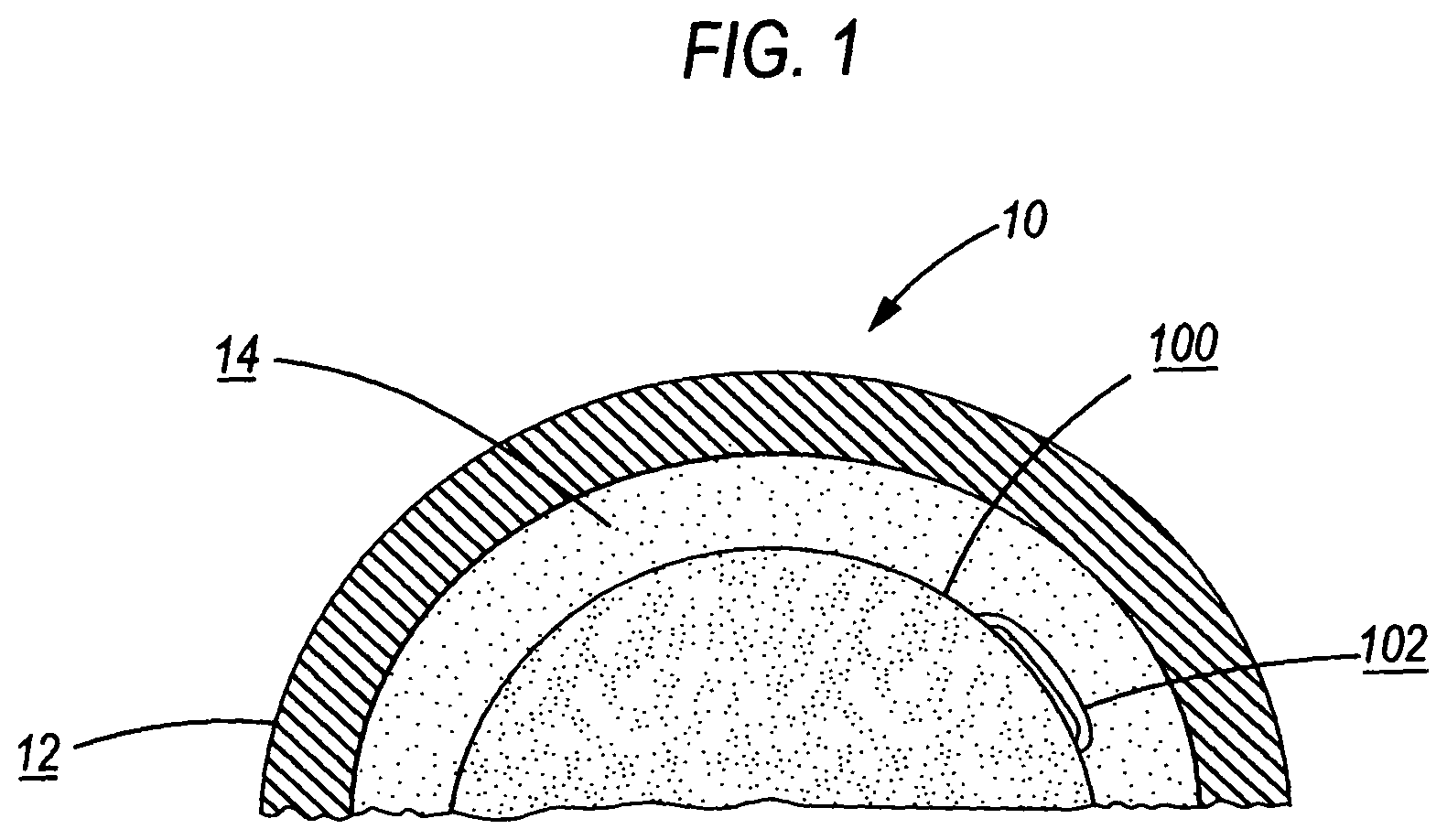 Patent US11779678 Figure 1 – Antimicrobial compression wrap