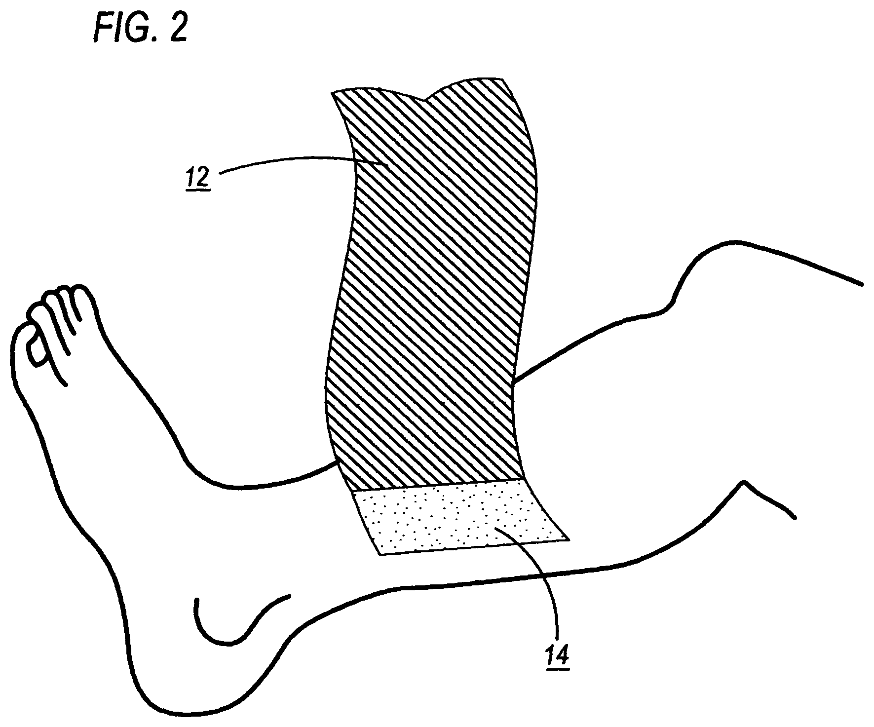Patent US11779678 Figure 2 – Antimicrobial compression wrap