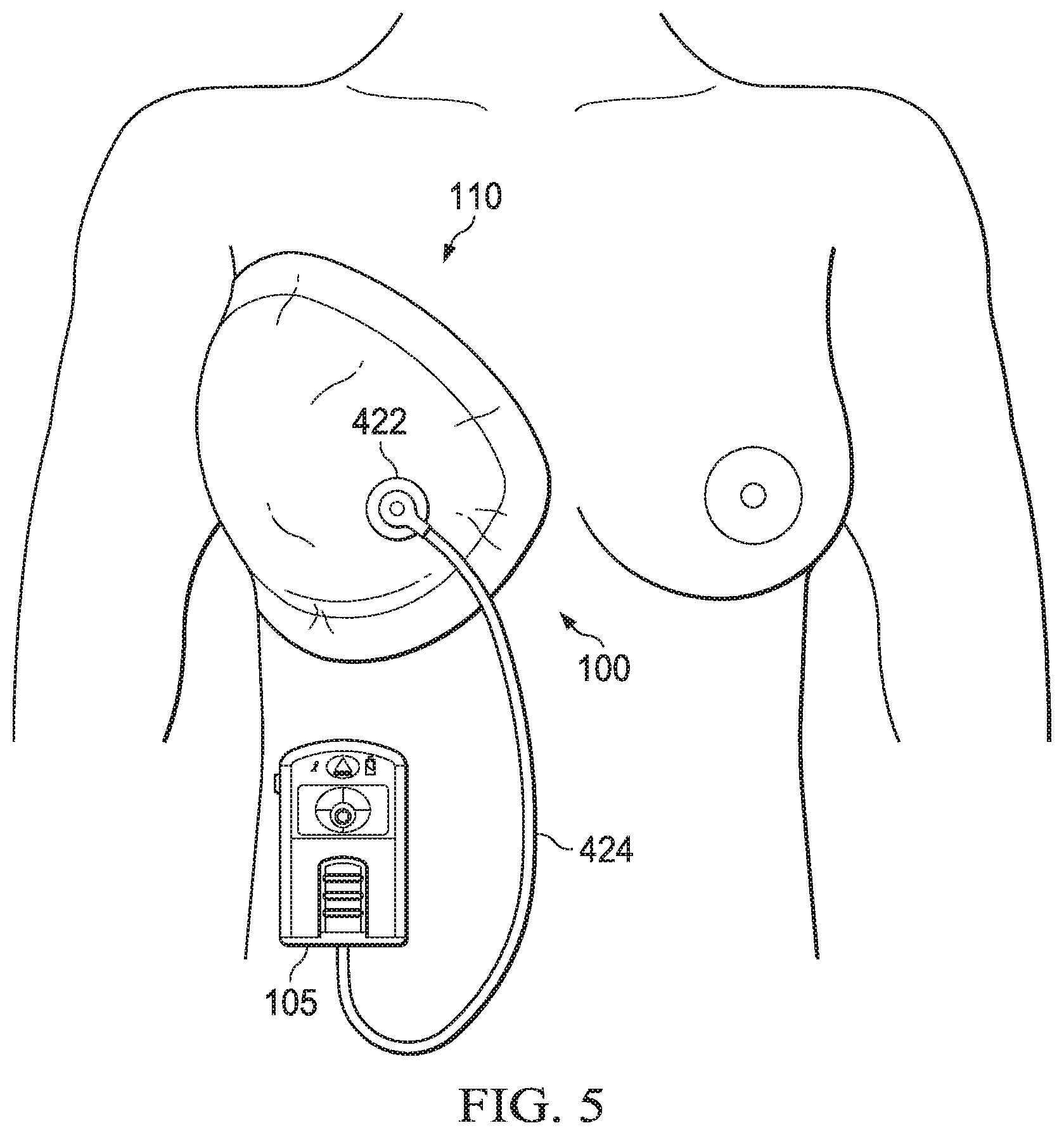 Patent US11779693 Figure 4 – Negative-pressure wound therapy dressing with zone of ambient pressure