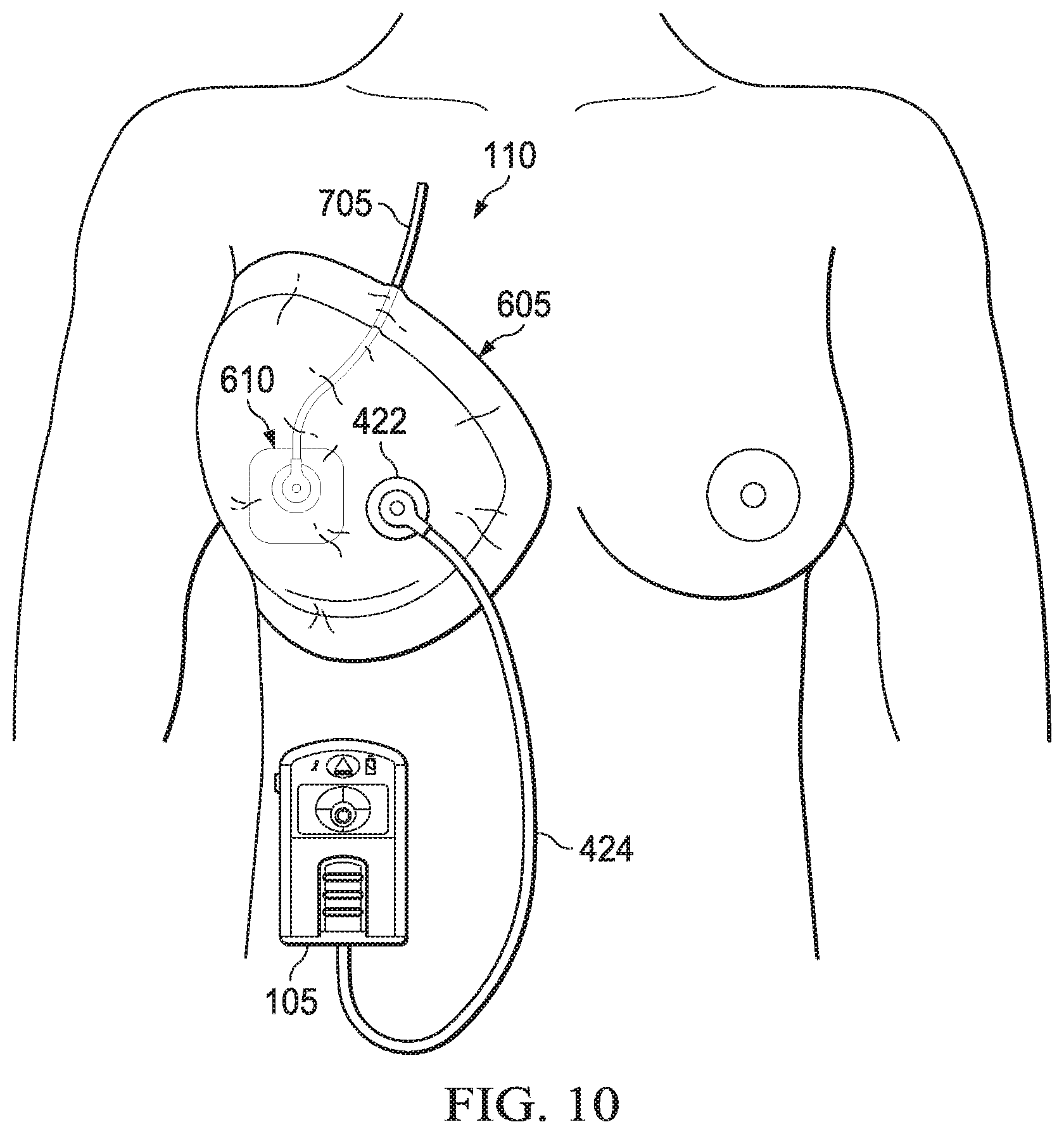 Patent US11779693 Figure 8 – Negative-pressure wound therapy dressing with zone of ambient pressure