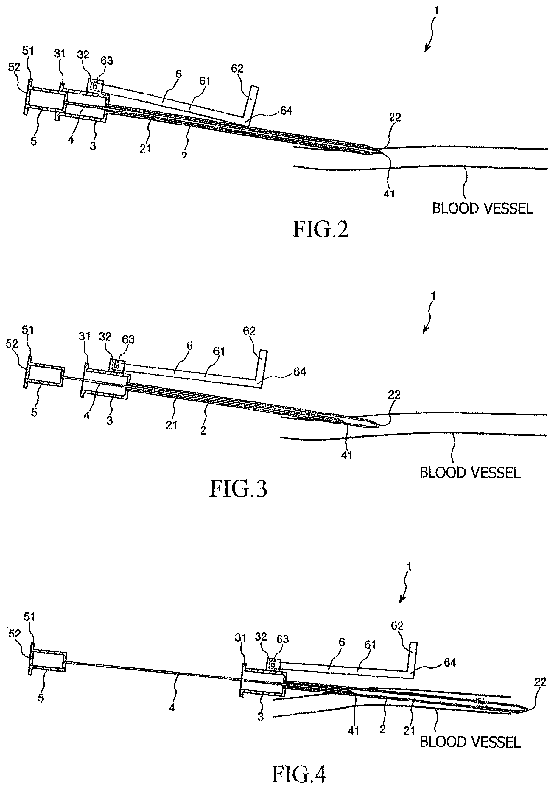 Patent US11779700 Figure 2 – Indwelling assembly