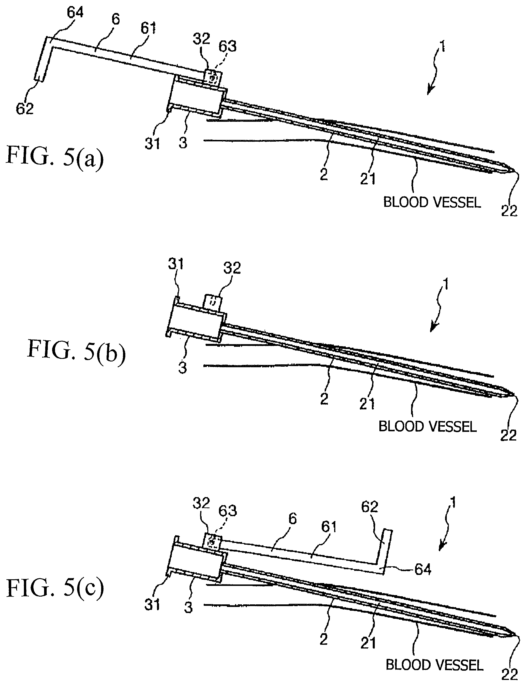Patent US11779700 Figure 3 – Indwelling assembly