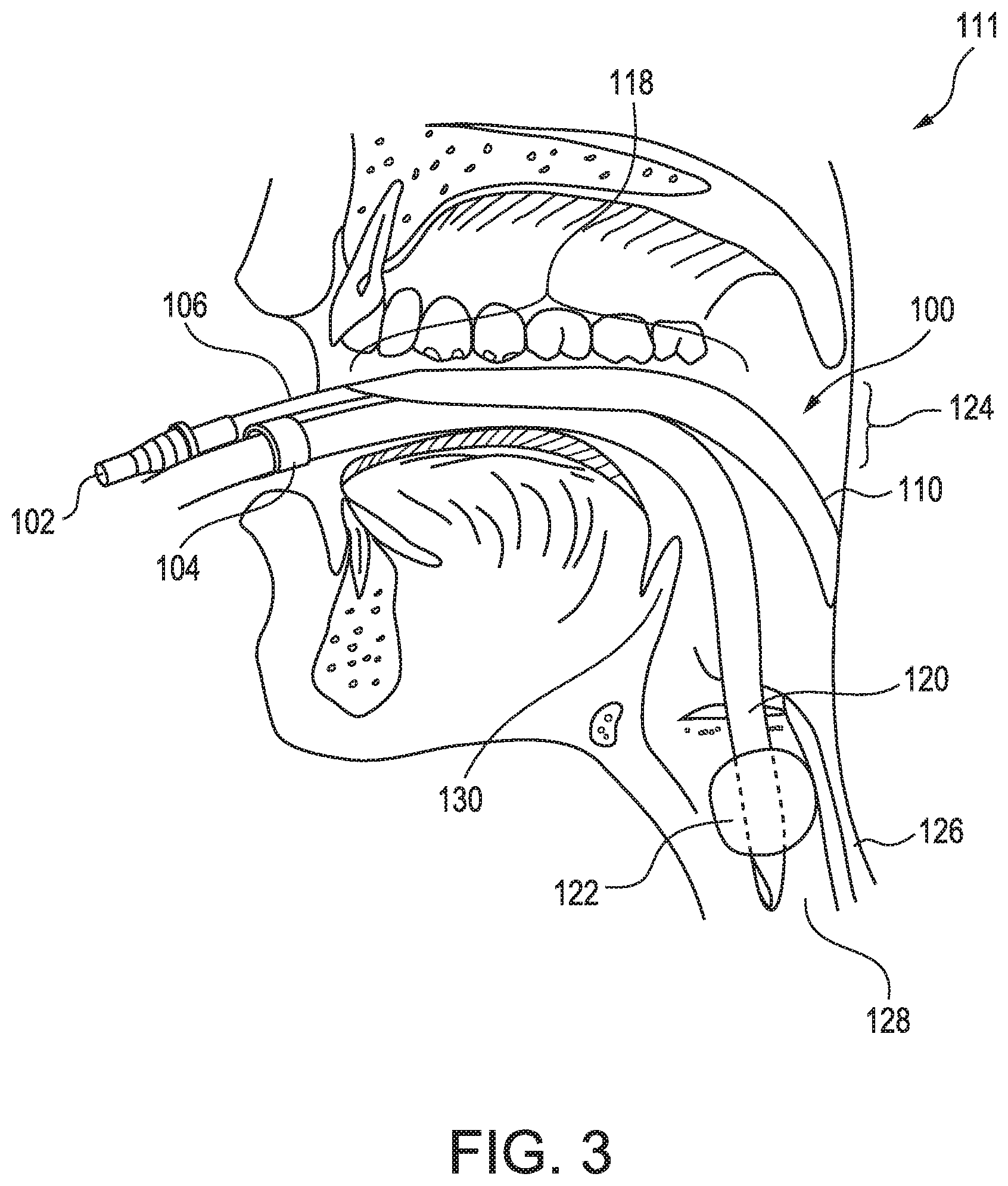 Patent US11779721 Figure 3 – Oral suction device