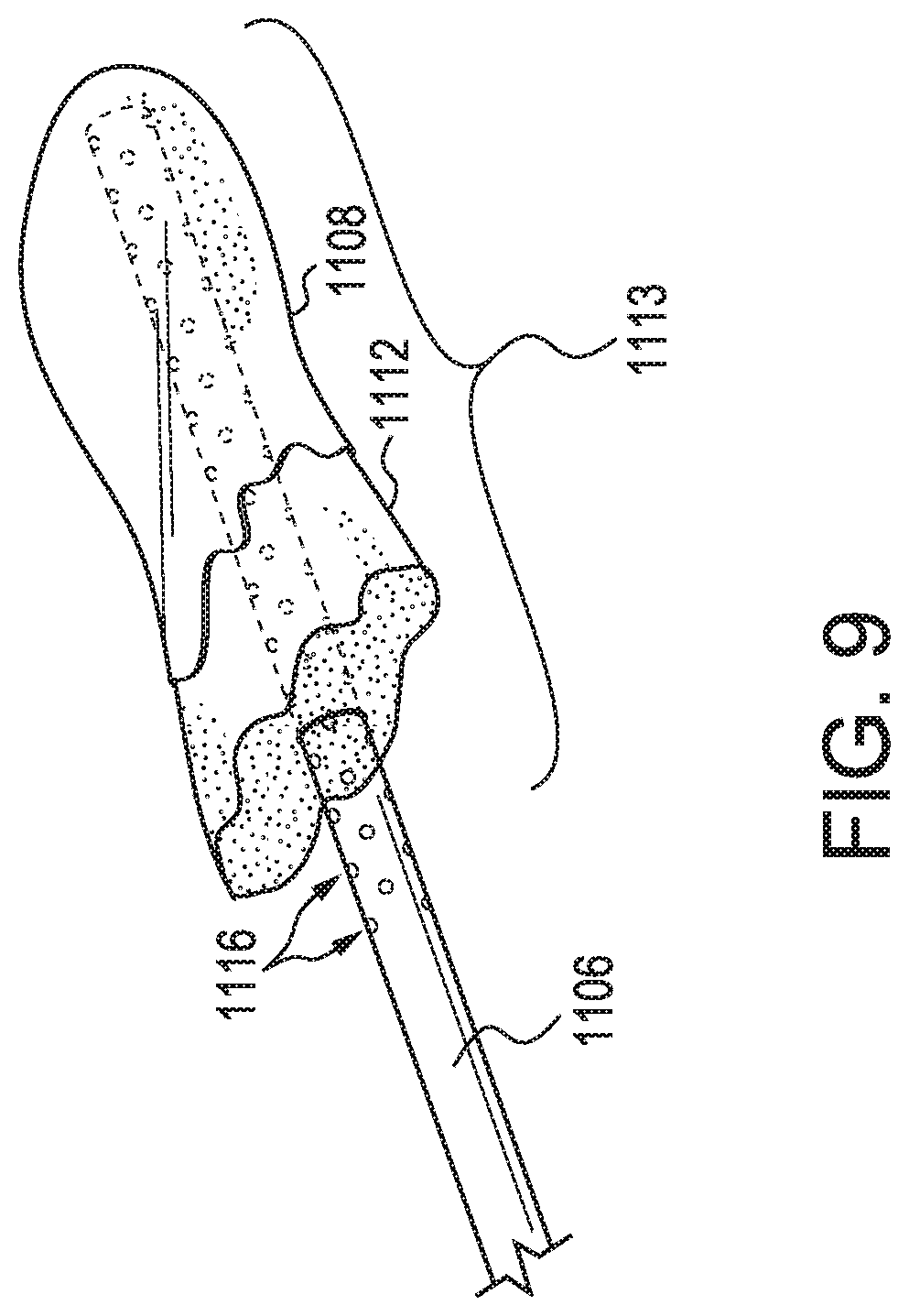 Patent US11779721 Figure 10 – Oral suction device