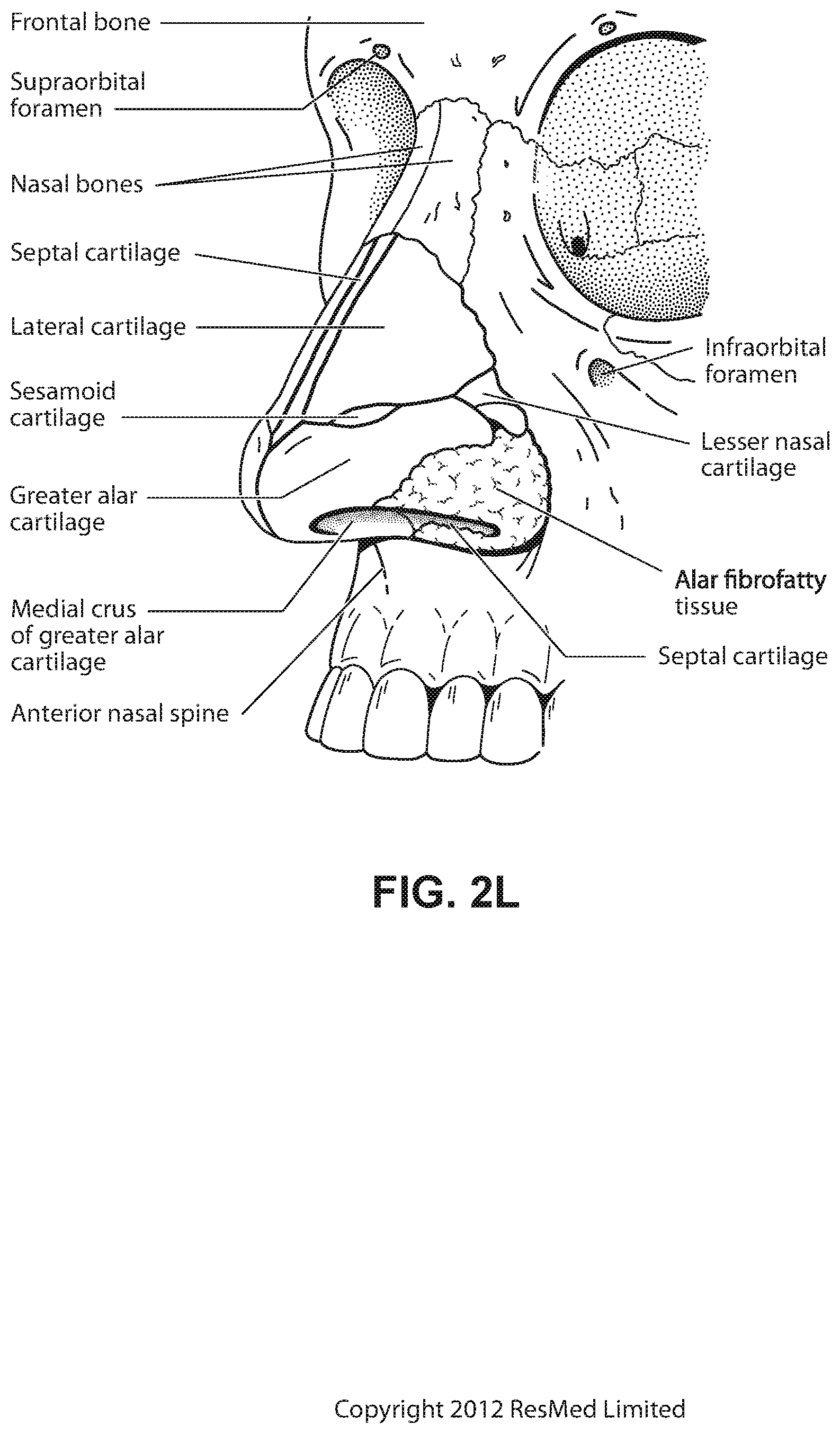 Patent US11779723 Figure 12 – Connector for positioning and stabilising structure