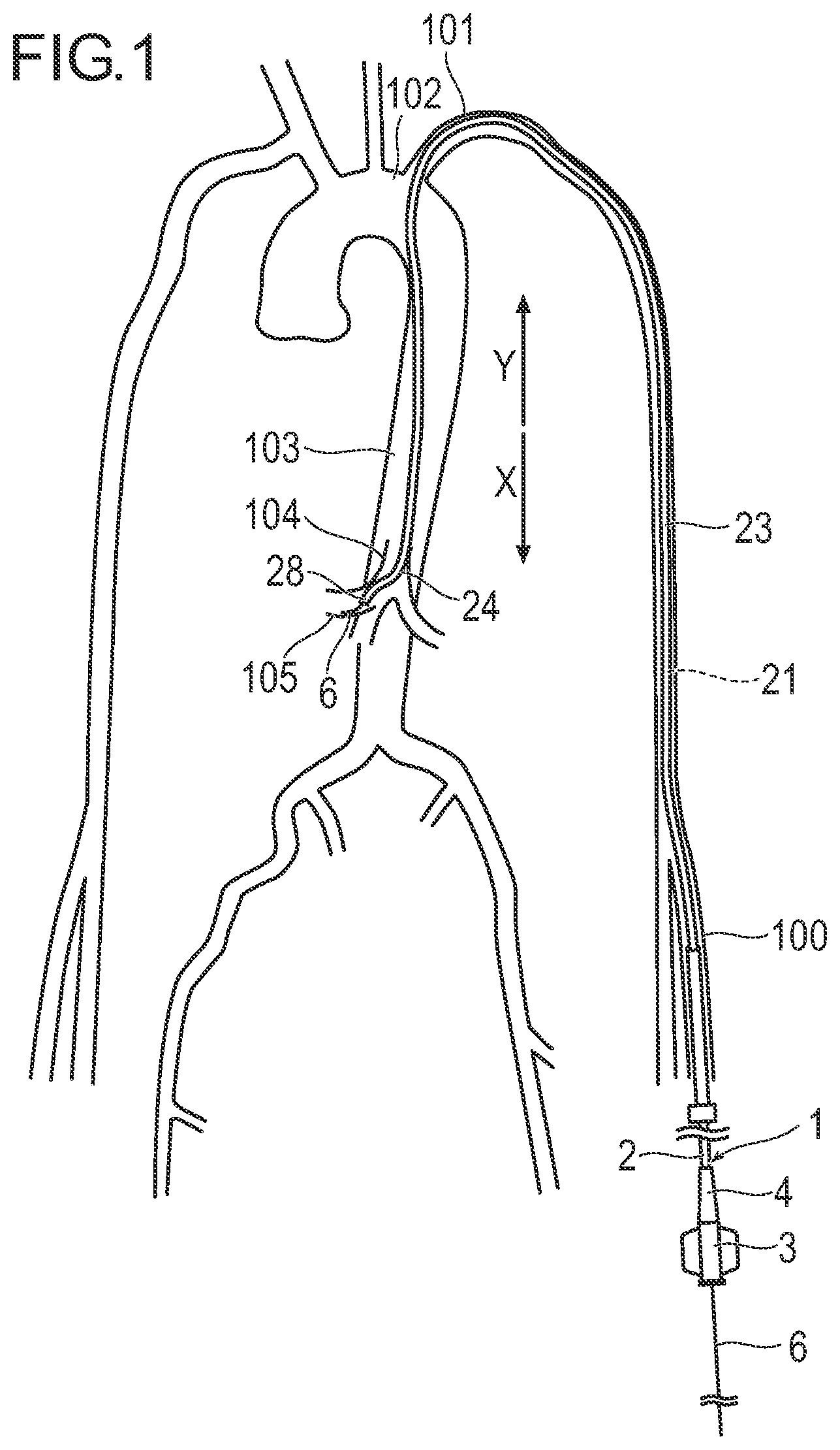Patent US11779729 Figure 1 – Catheter and method of engaging catheter