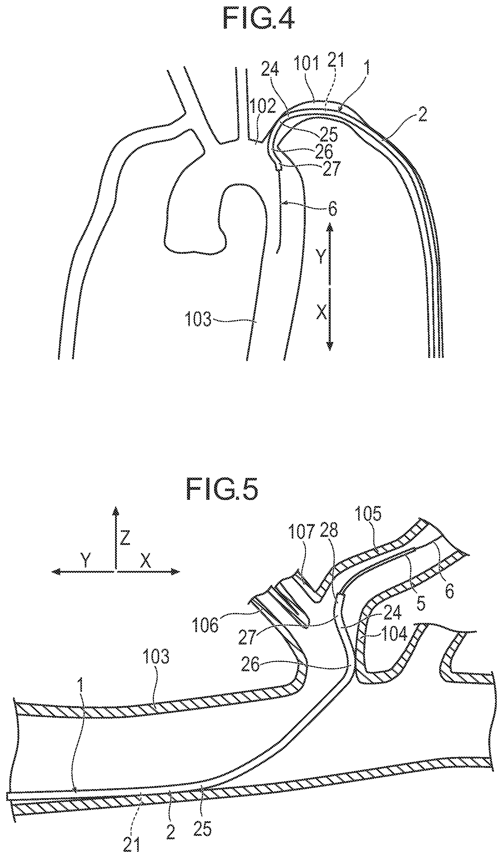Patent US11779729 Figure 3 – Catheter and method of engaging catheter
