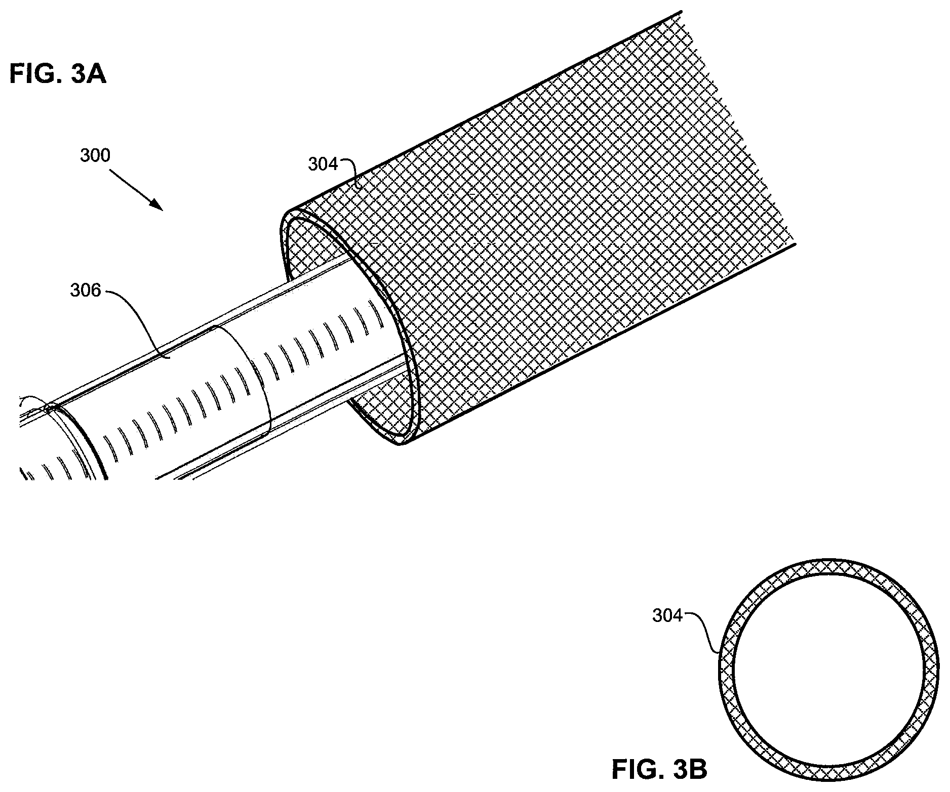 Patent US11779731 Figure 4 – Delivery catheter systems and methods