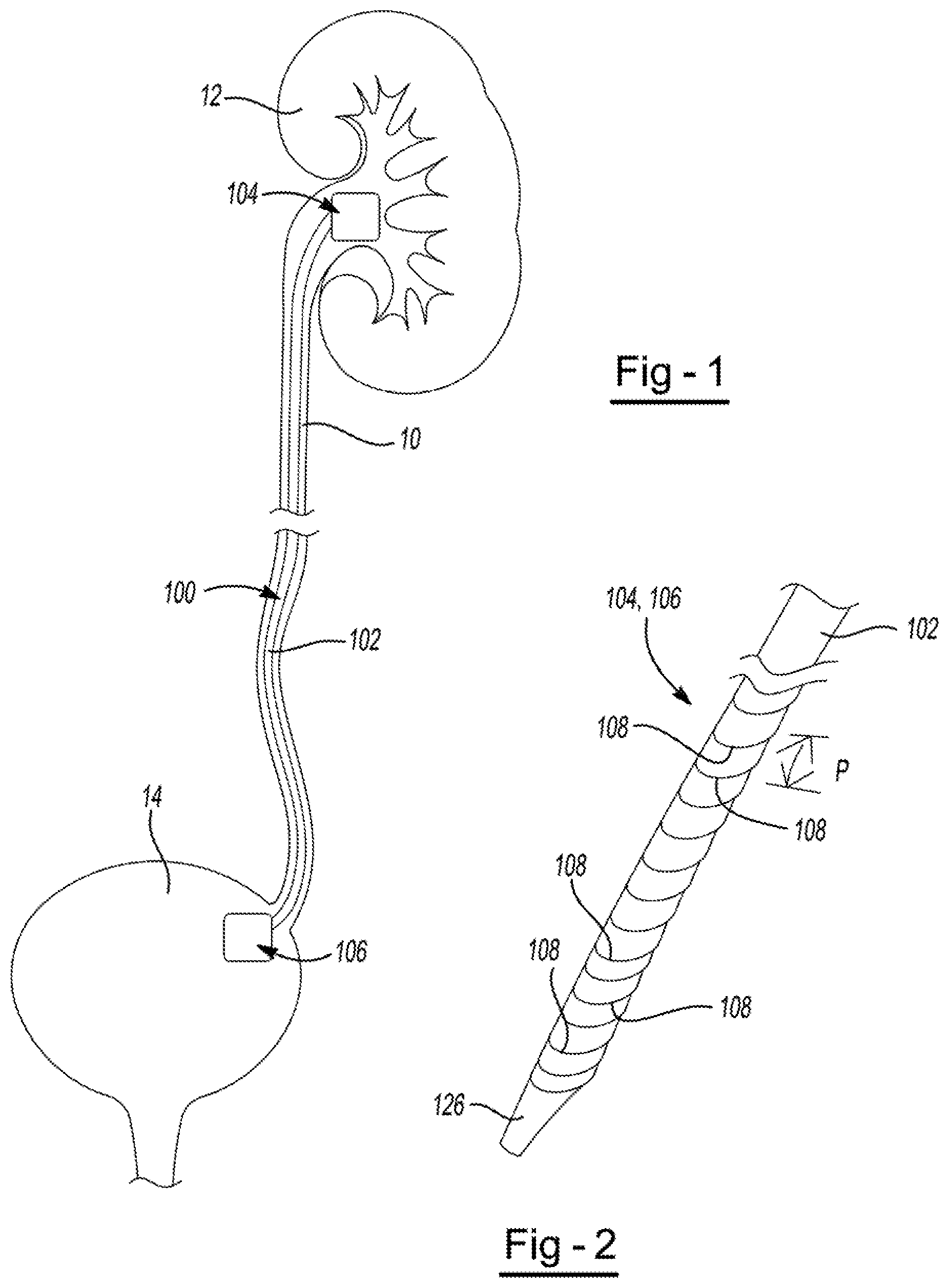 Patent US11779737 Figure 1 – Ureteral stent