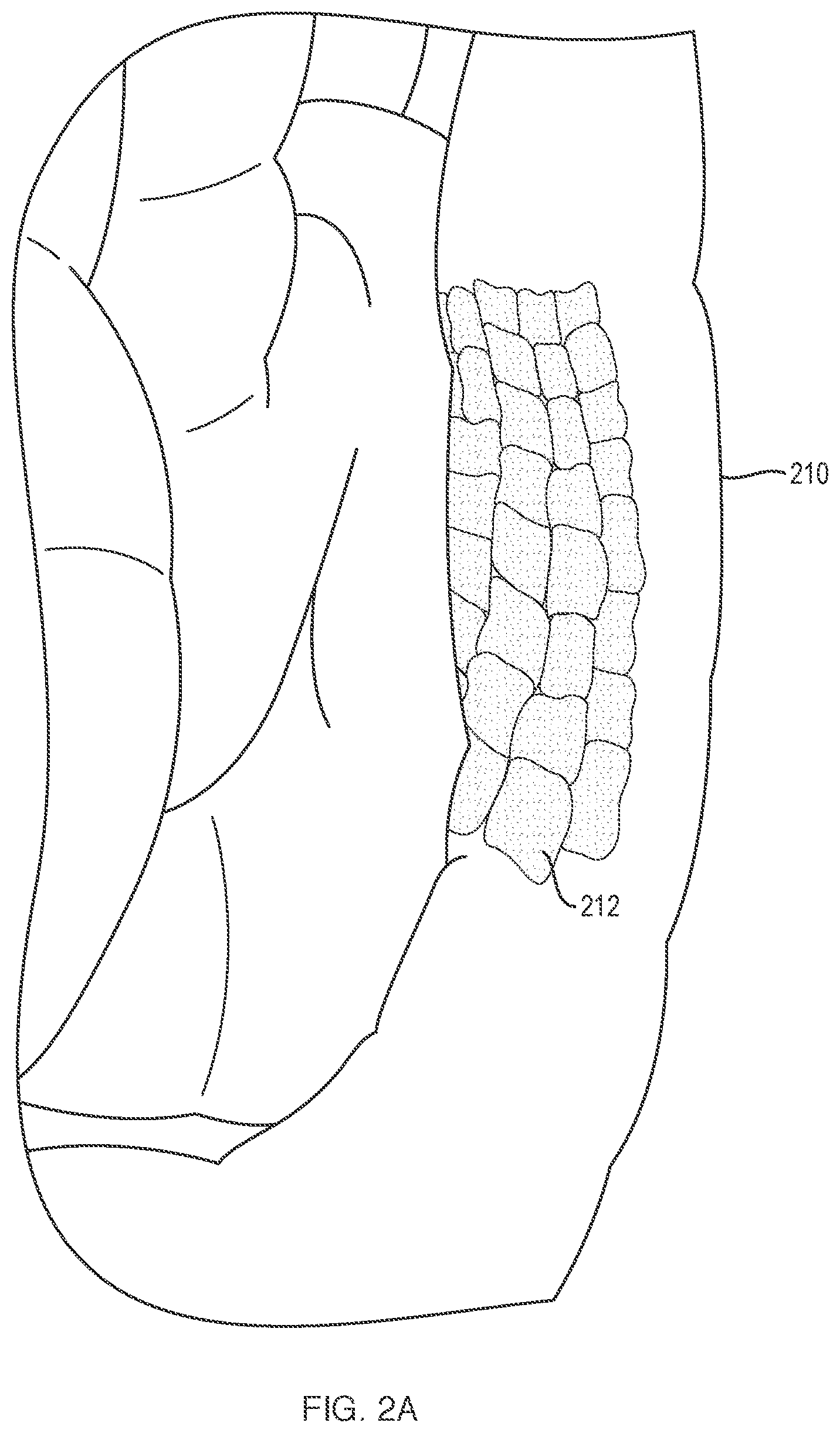Patent US11779738 Figure 3 – Extracellular matrix delivery device