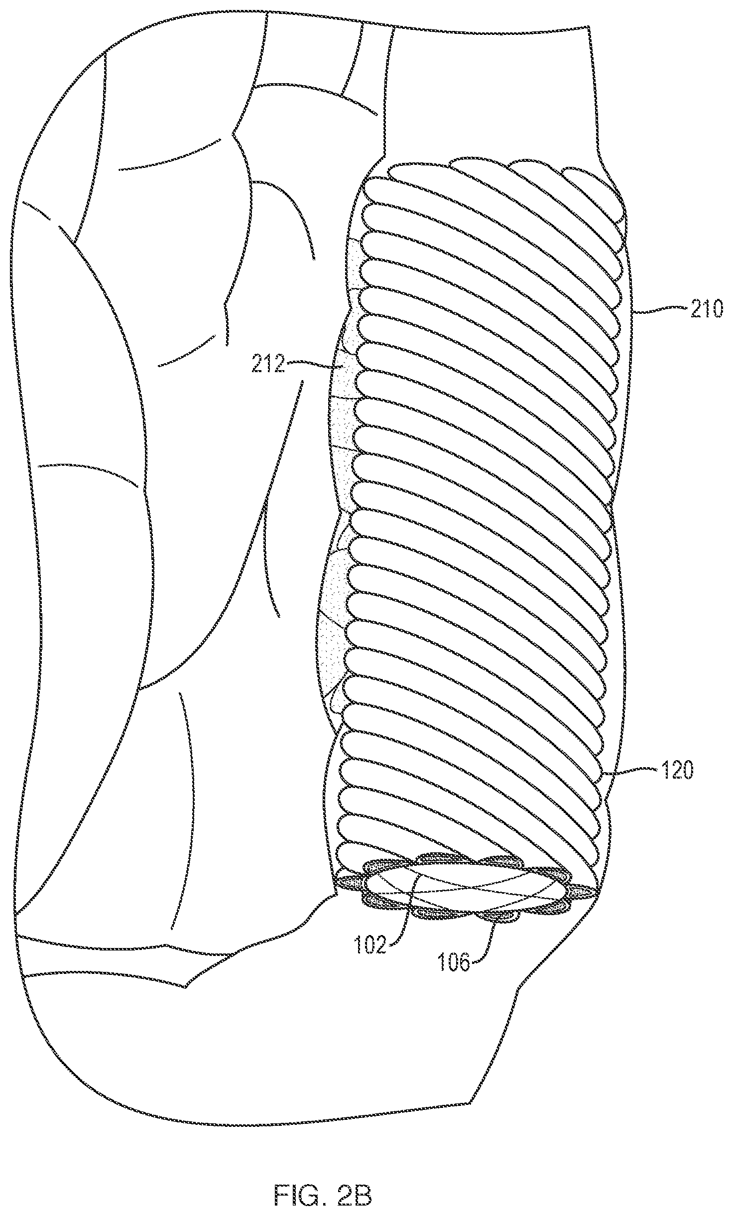 Patent US11779738 Figure 4 – Extracellular matrix delivery device