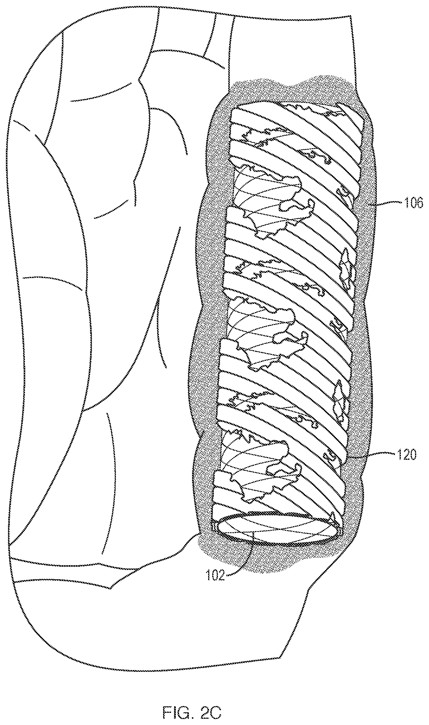 Patent US11779738 Figure 5 – Extracellular matrix delivery device