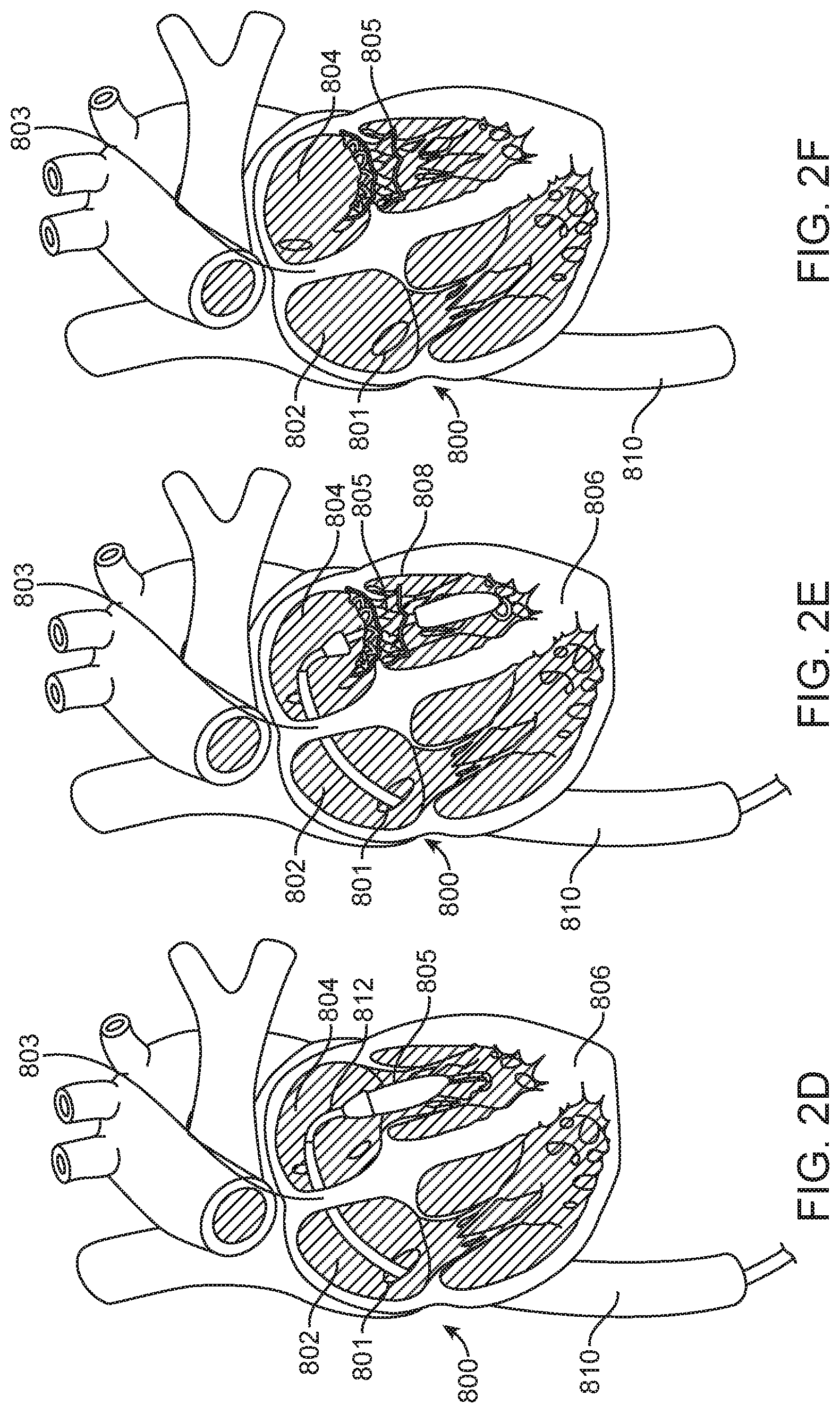 Patent US11779742 Figure 3 – Introducer with hemostasis mechanism