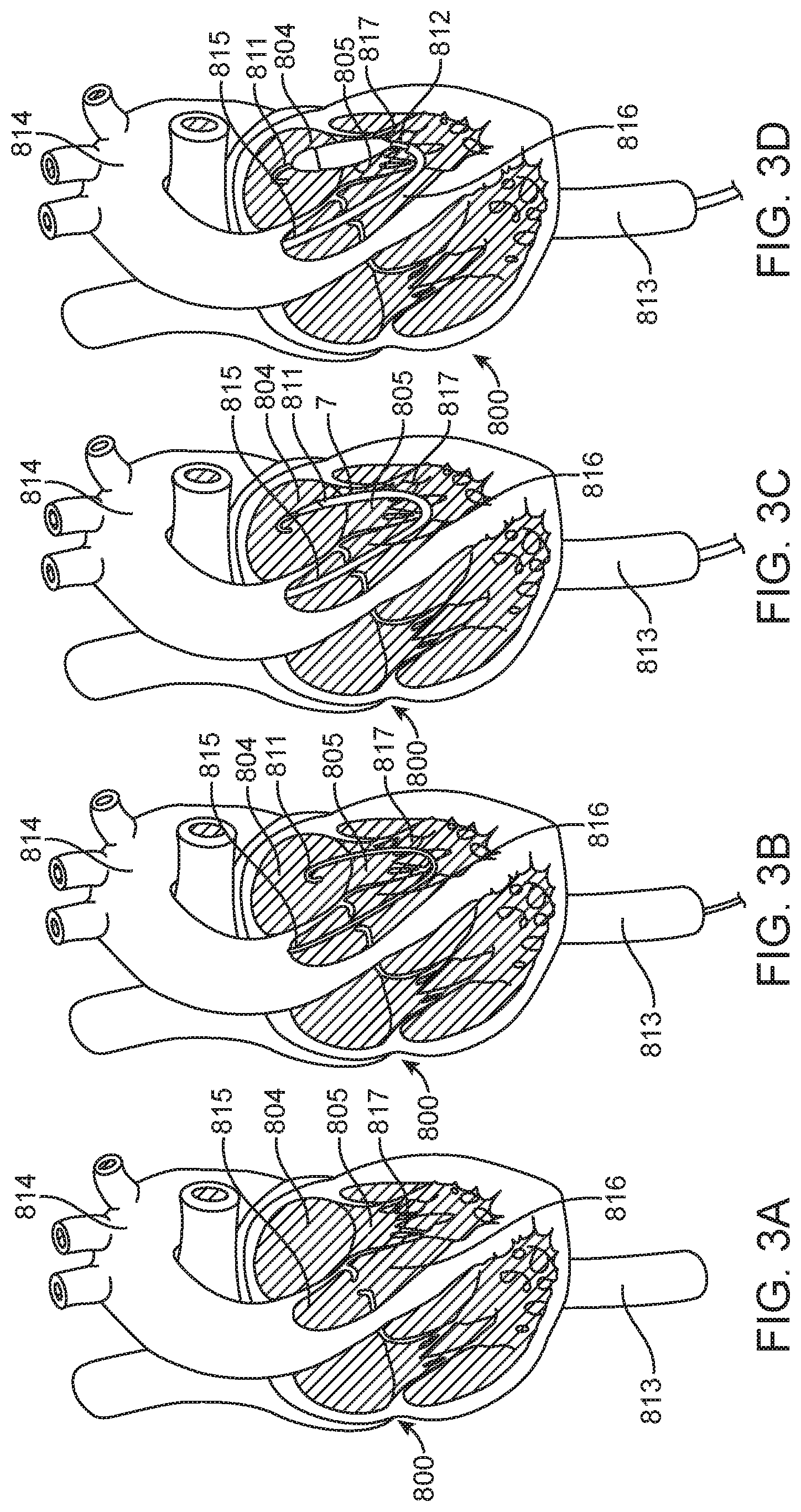 Patent US11779742 Figure 4 – Introducer with hemostasis mechanism