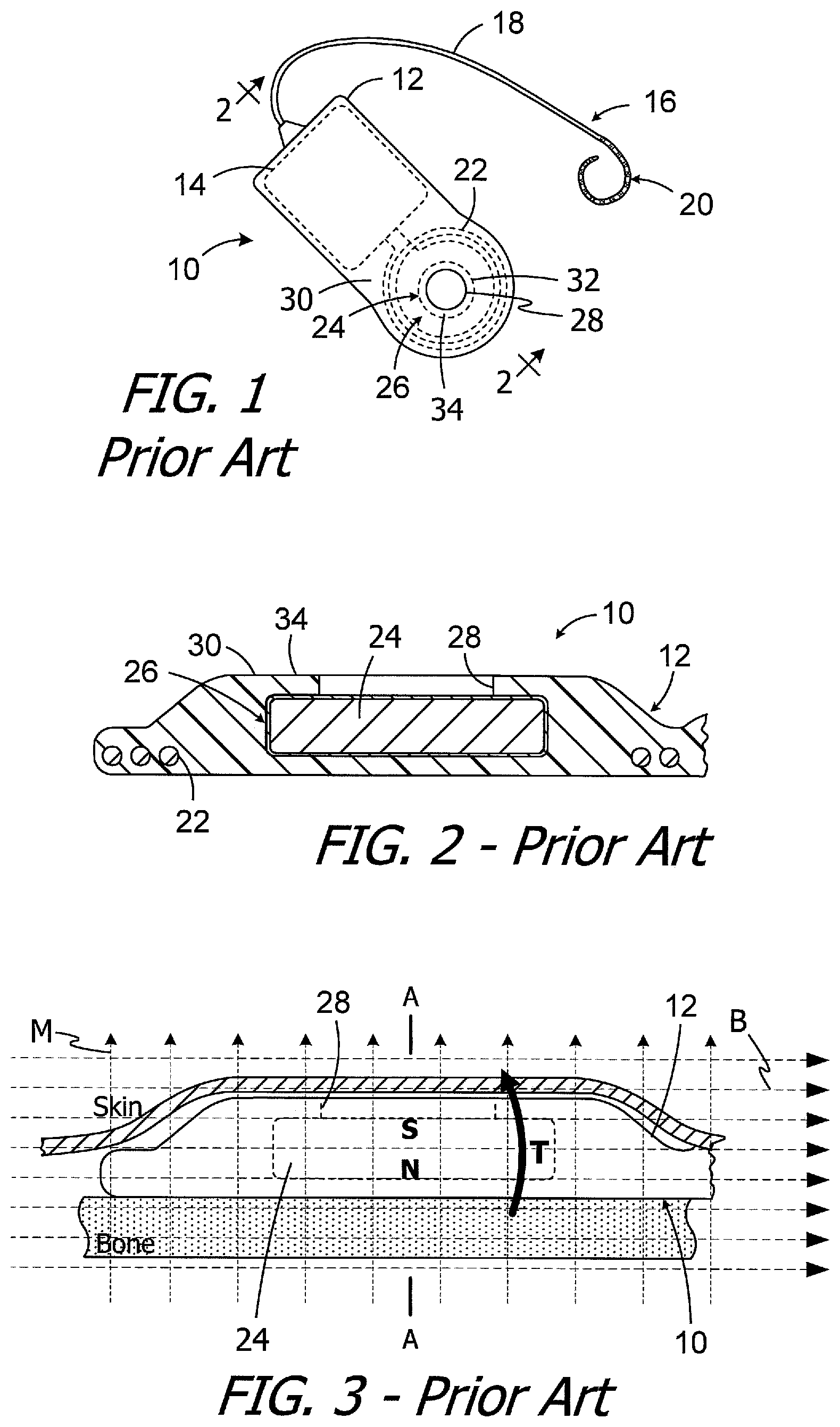Patent US11779754 — Cochlear implants, magnets for use with same and magnet retrofit methods — Figure 1