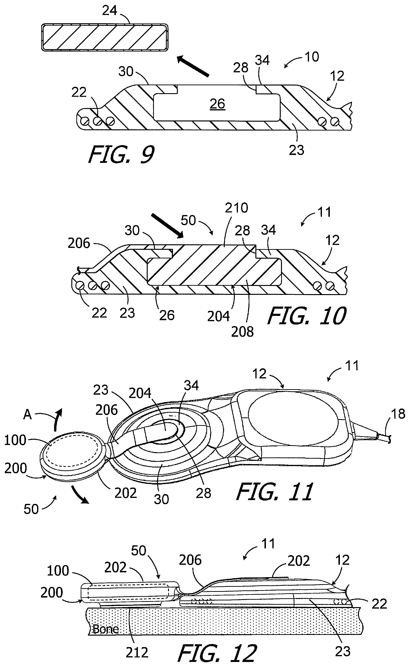 Patent US11779754 Figure 3 – Cochlear implants, magnets for use with same and magnet retrofit methods