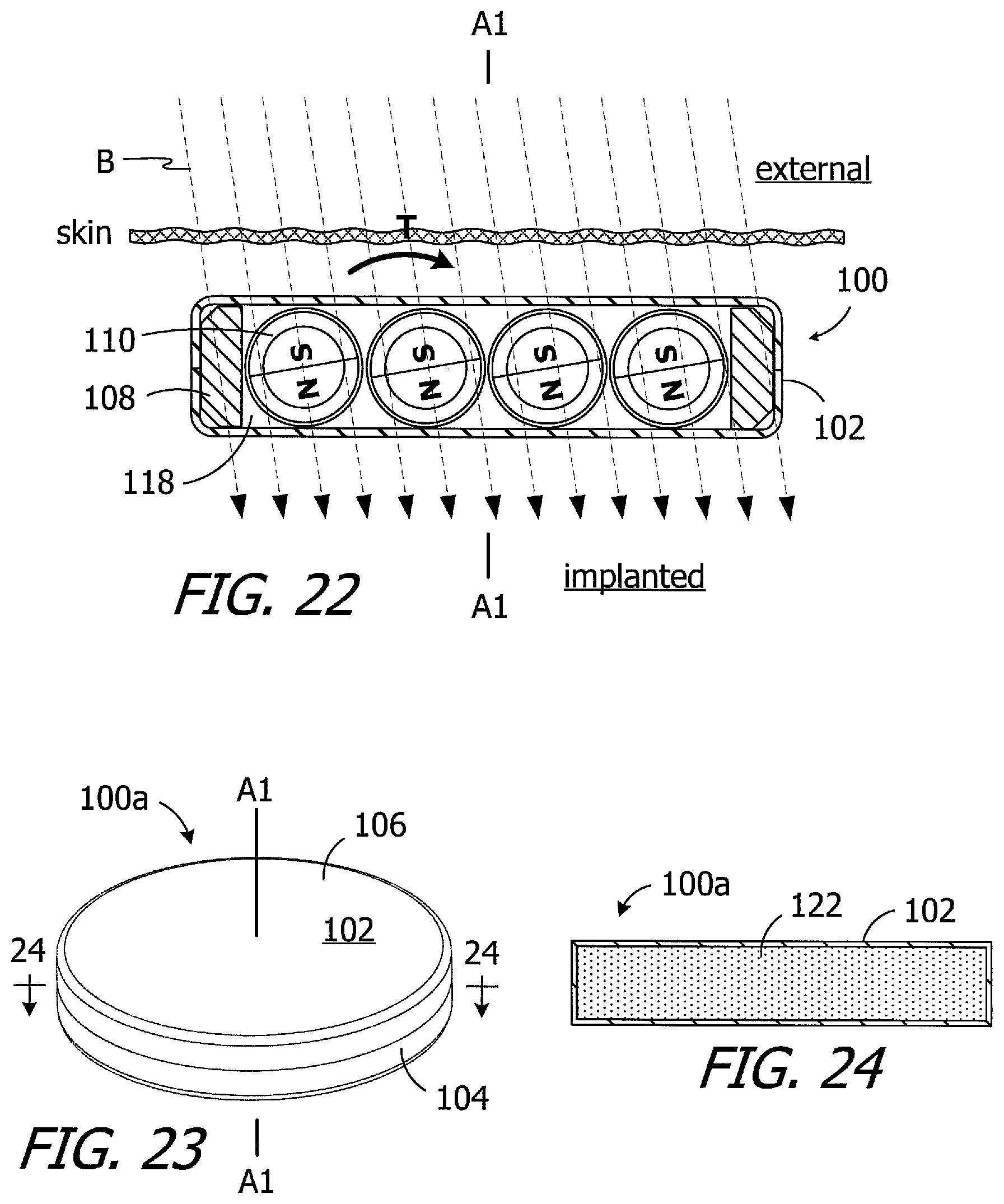 Patent US11779754 Figure 6 – Cochlear implants, magnets for use with same and magnet retrofit methods