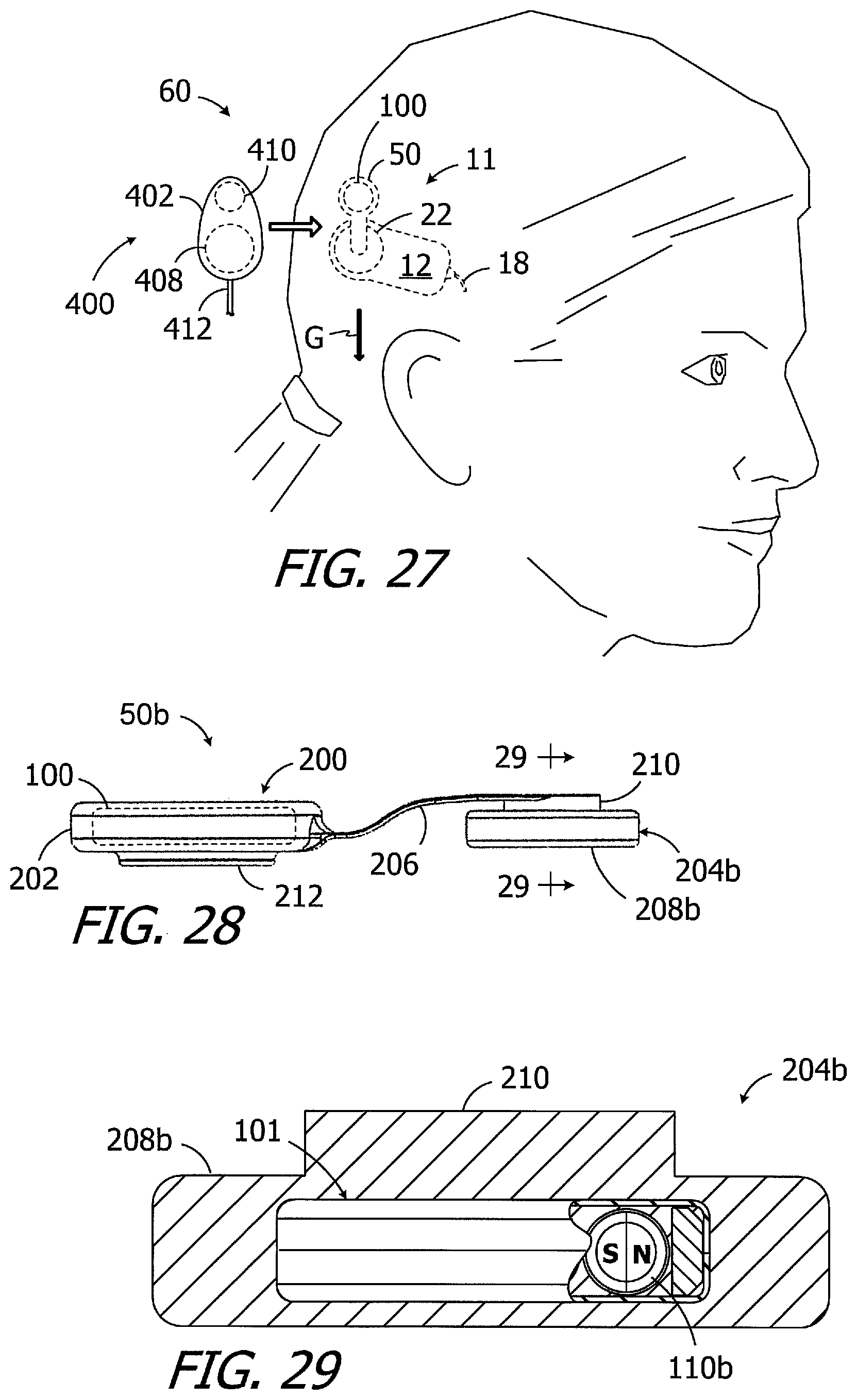 Patent US11779754 Figure 8 – Cochlear implants, magnets for use with same and magnet retrofit methods