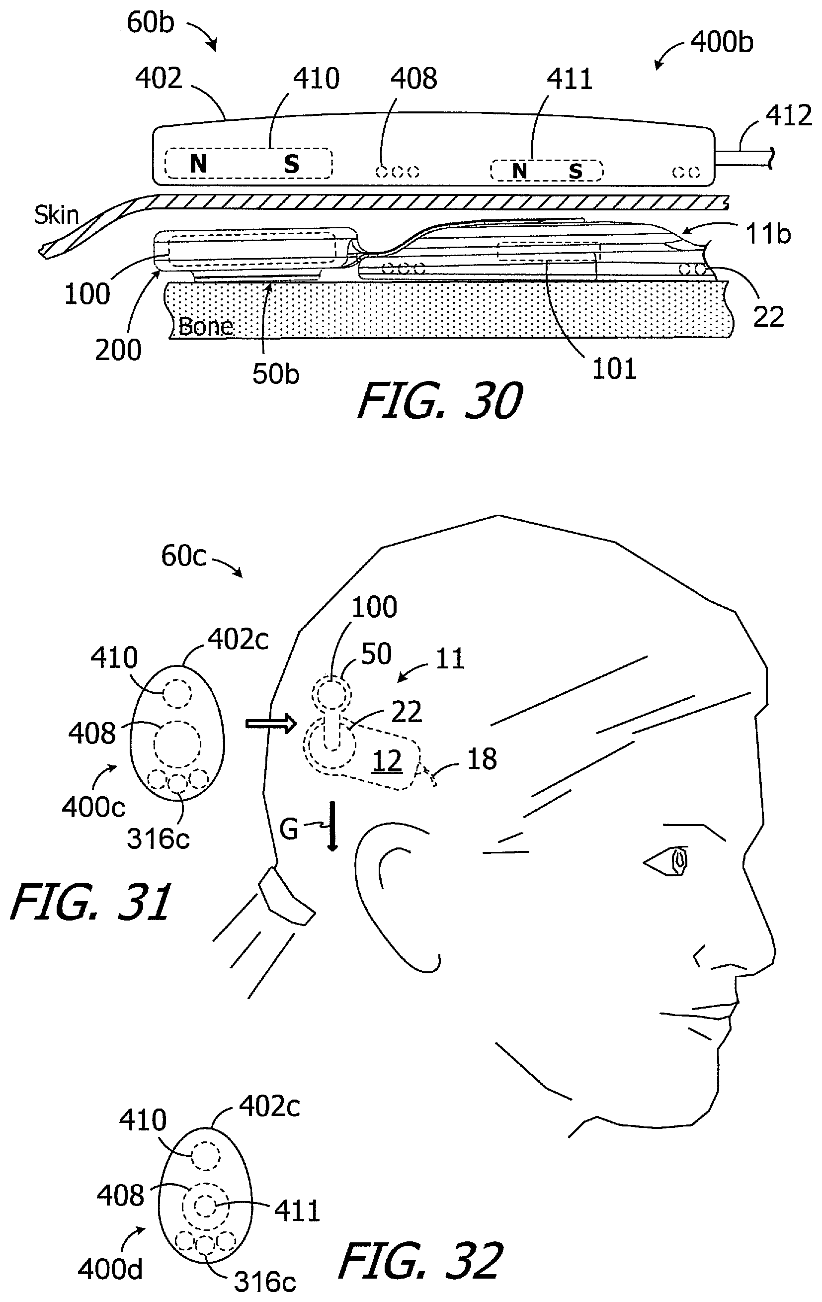 Patent US11779754 Figure 9 – Cochlear implants, magnets for use with same and magnet retrofit methods