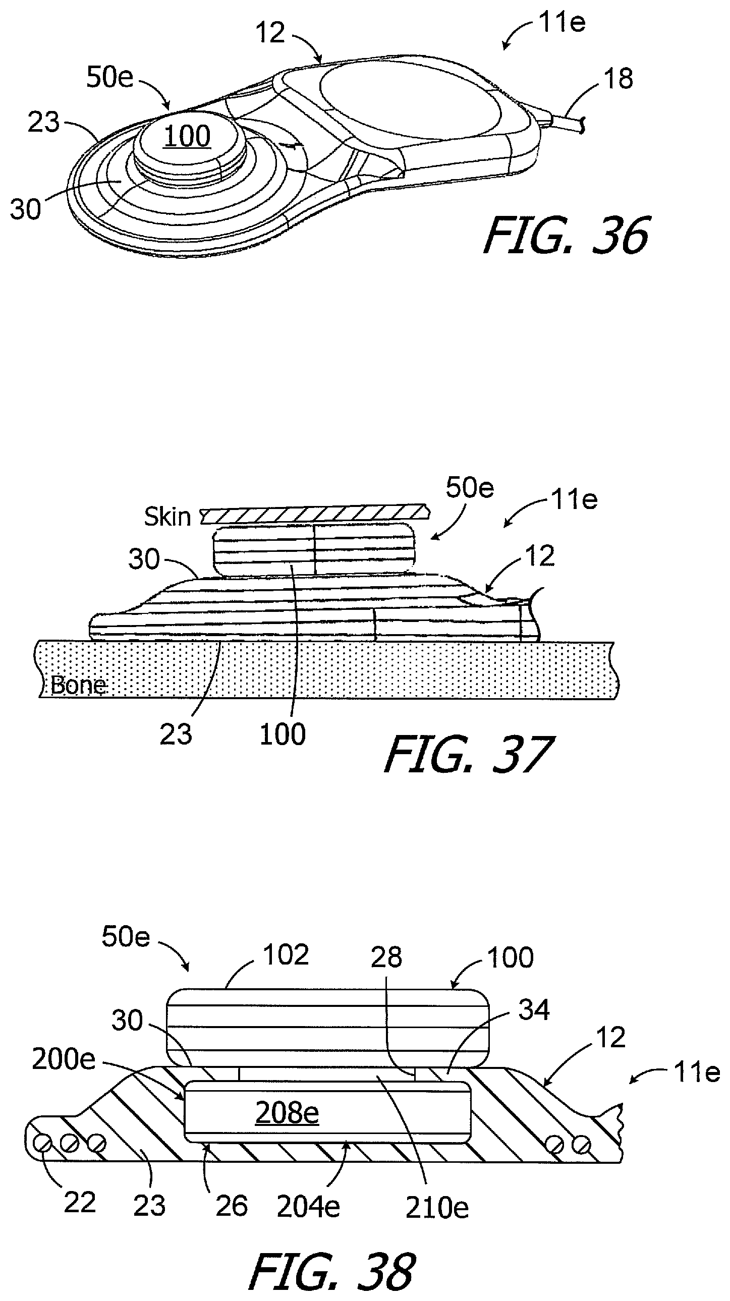 Patent US11779754 Figure 11 – Cochlear implants, magnets for use with same and magnet retrofit methods