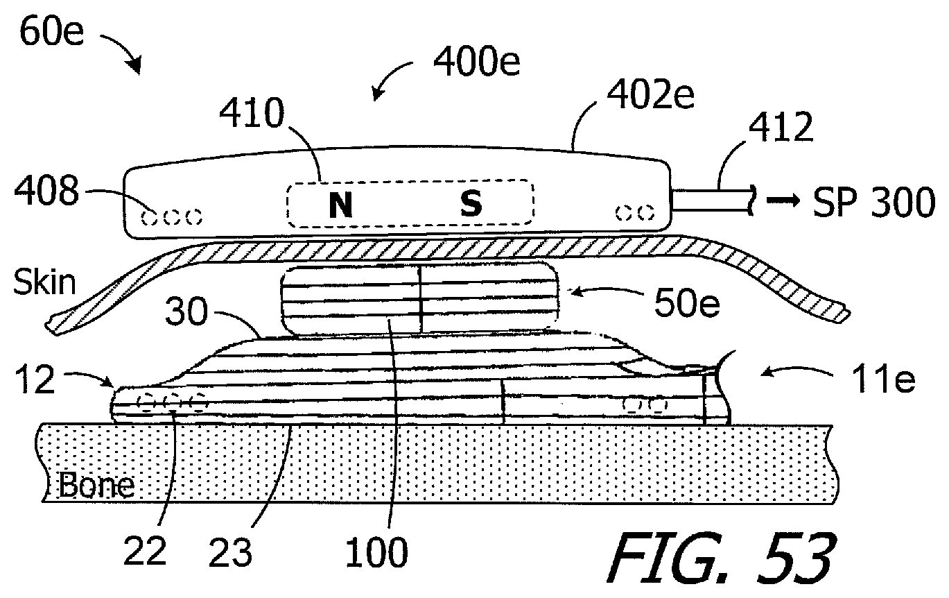 Patent US11779754 Figure 15 – Cochlear implants, magnets for use with same and magnet retrofit methods