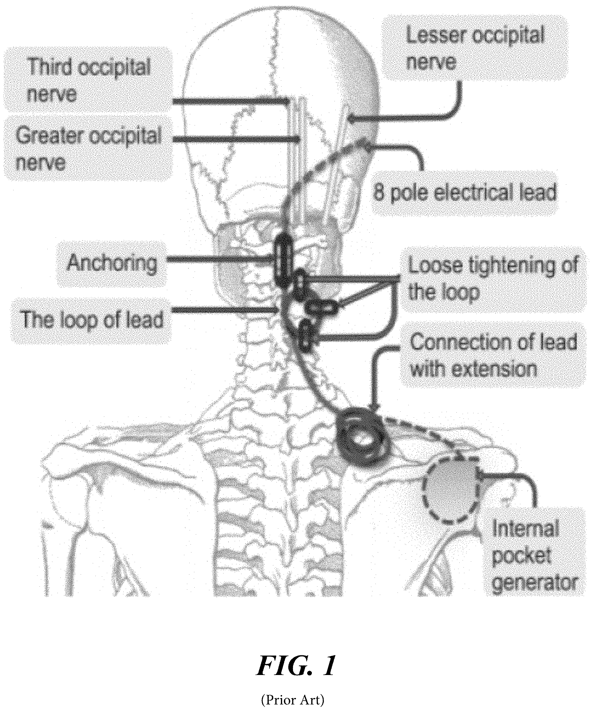 Patent US11779755 — System and methods for therapeutic stimulation — Figure 1