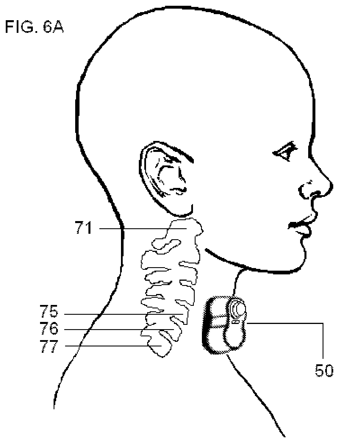 Patent US11779756 Figure 10 – Systems and methods for vagal nerve stimulation
