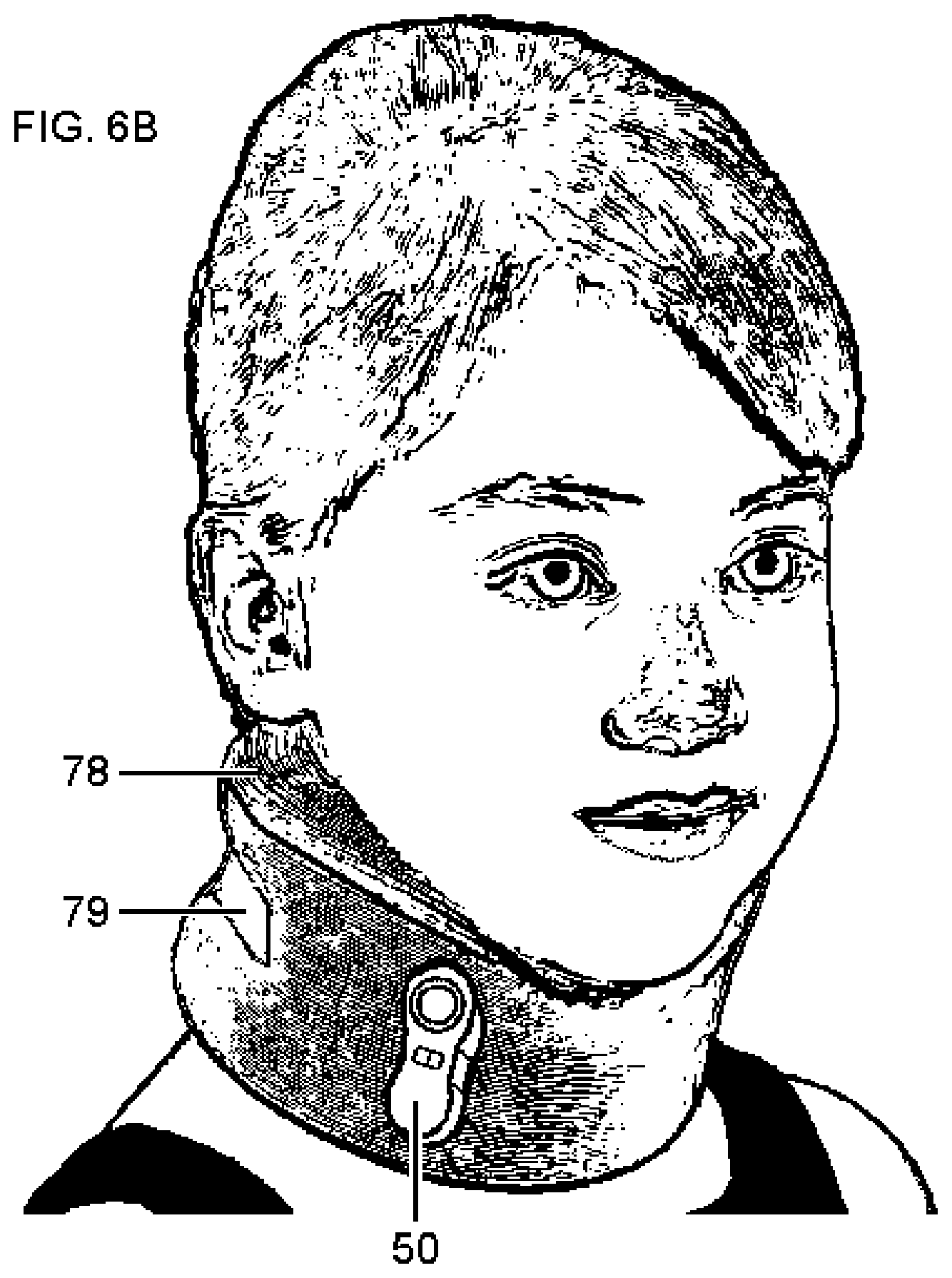 Patent US11779756 Figure 11 – Systems and methods for vagal nerve stimulation