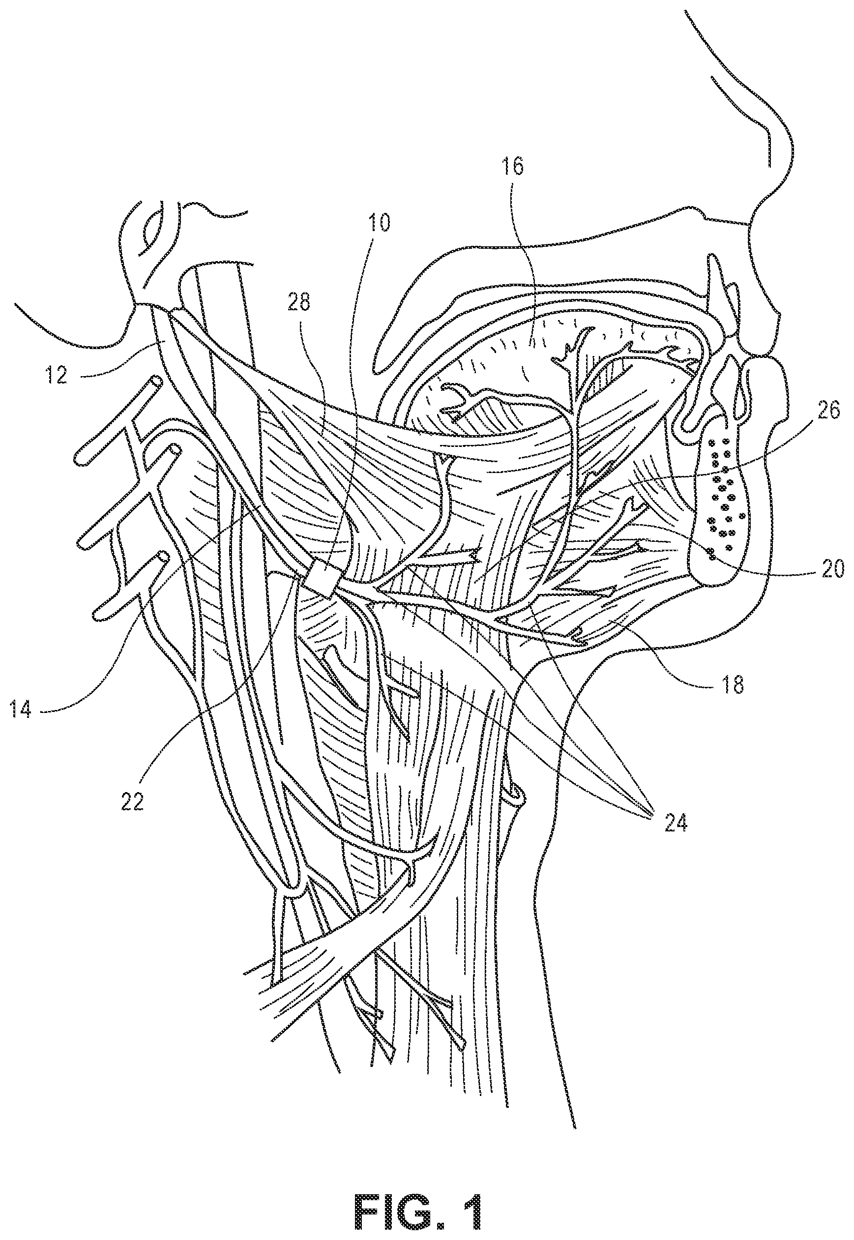 Patent US11779759 Figure 1 – Stimulator systems and methods for selectively recruiting fascicles in hypoglossal nerve trunk