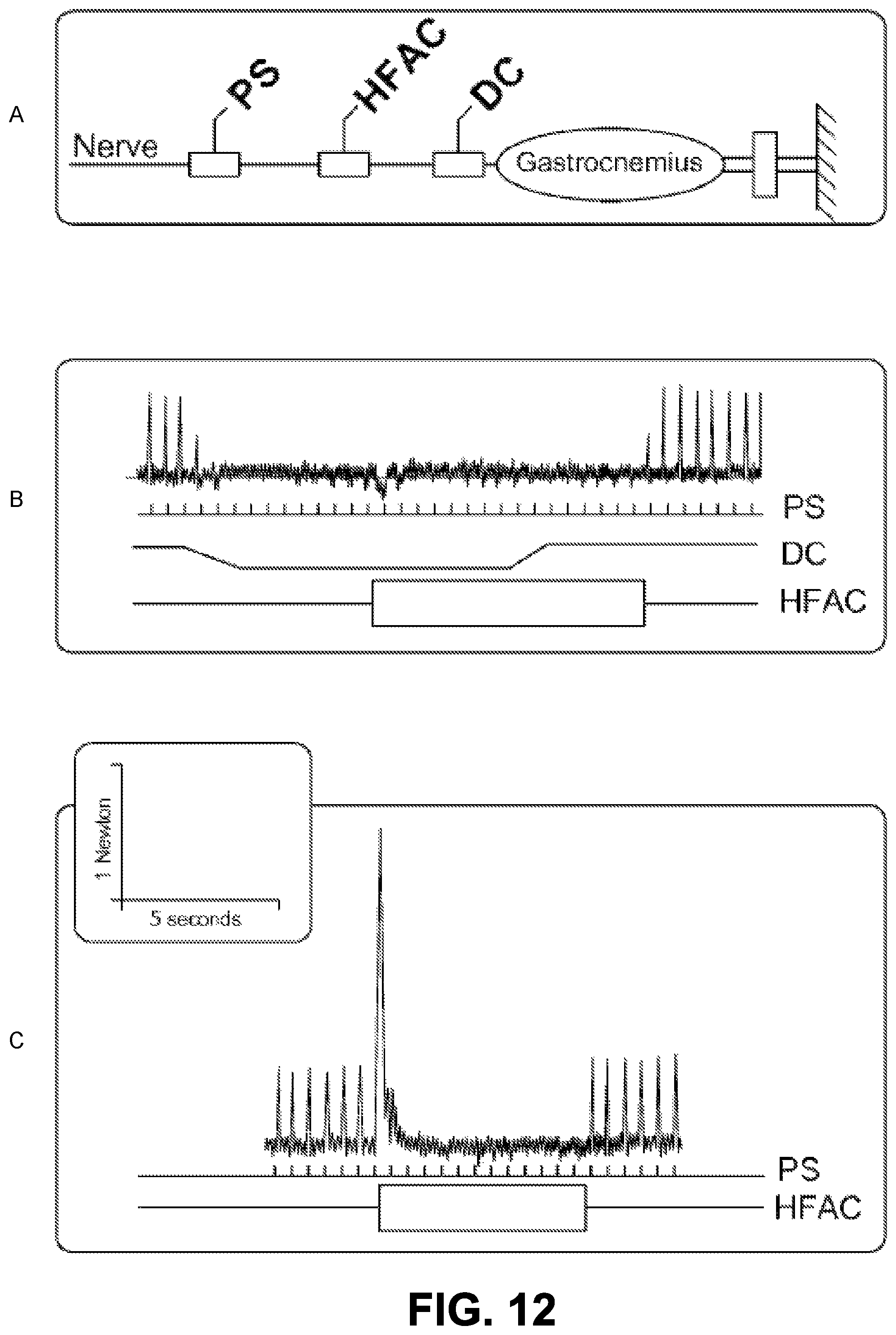 Patent US11779762 Figure 11 – Systems for treatment of a neurological disorder using electrical nerve conduction block