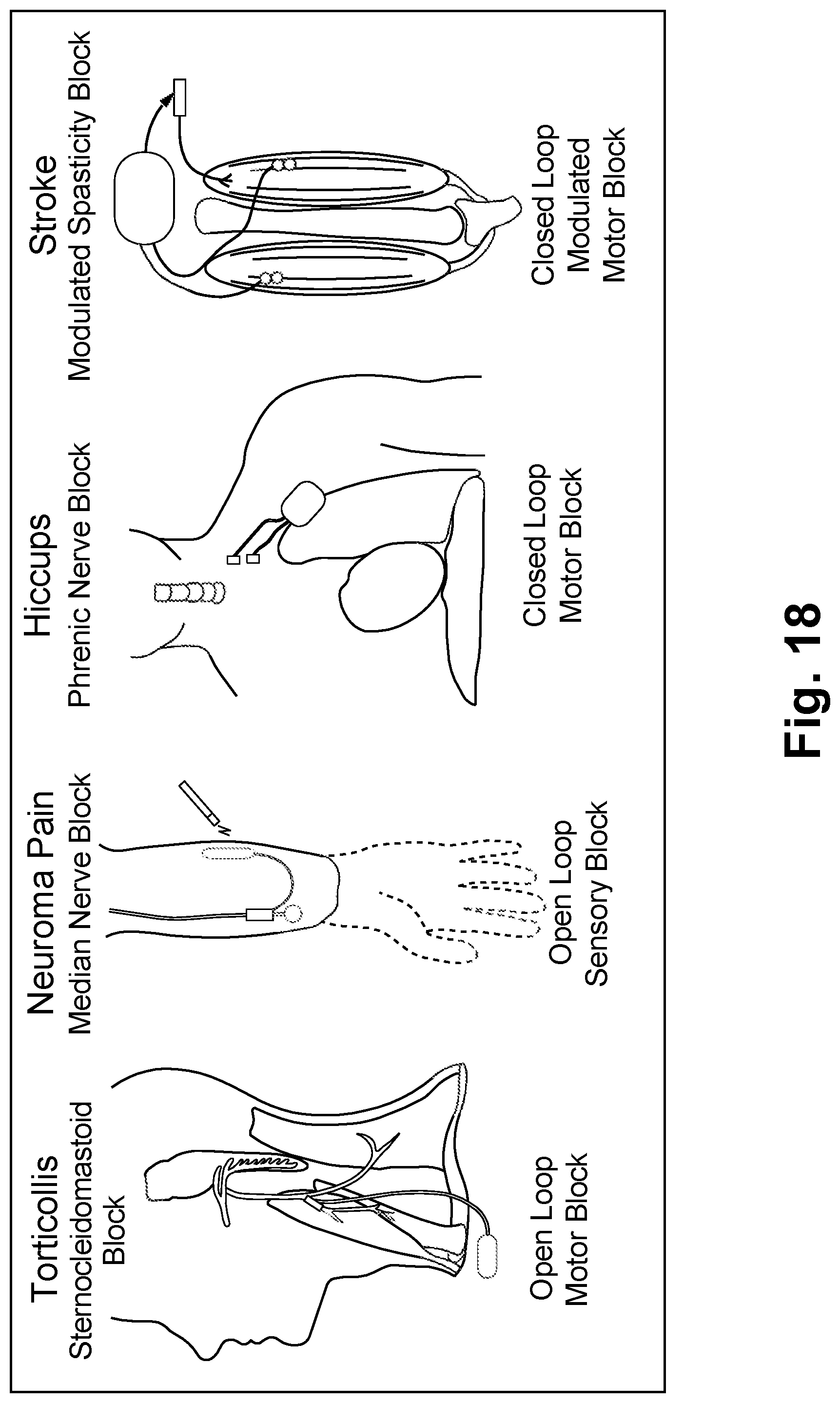 Patent US11779762 Figure 17 – Systems for treatment of a neurological disorder using electrical nerve conduction block