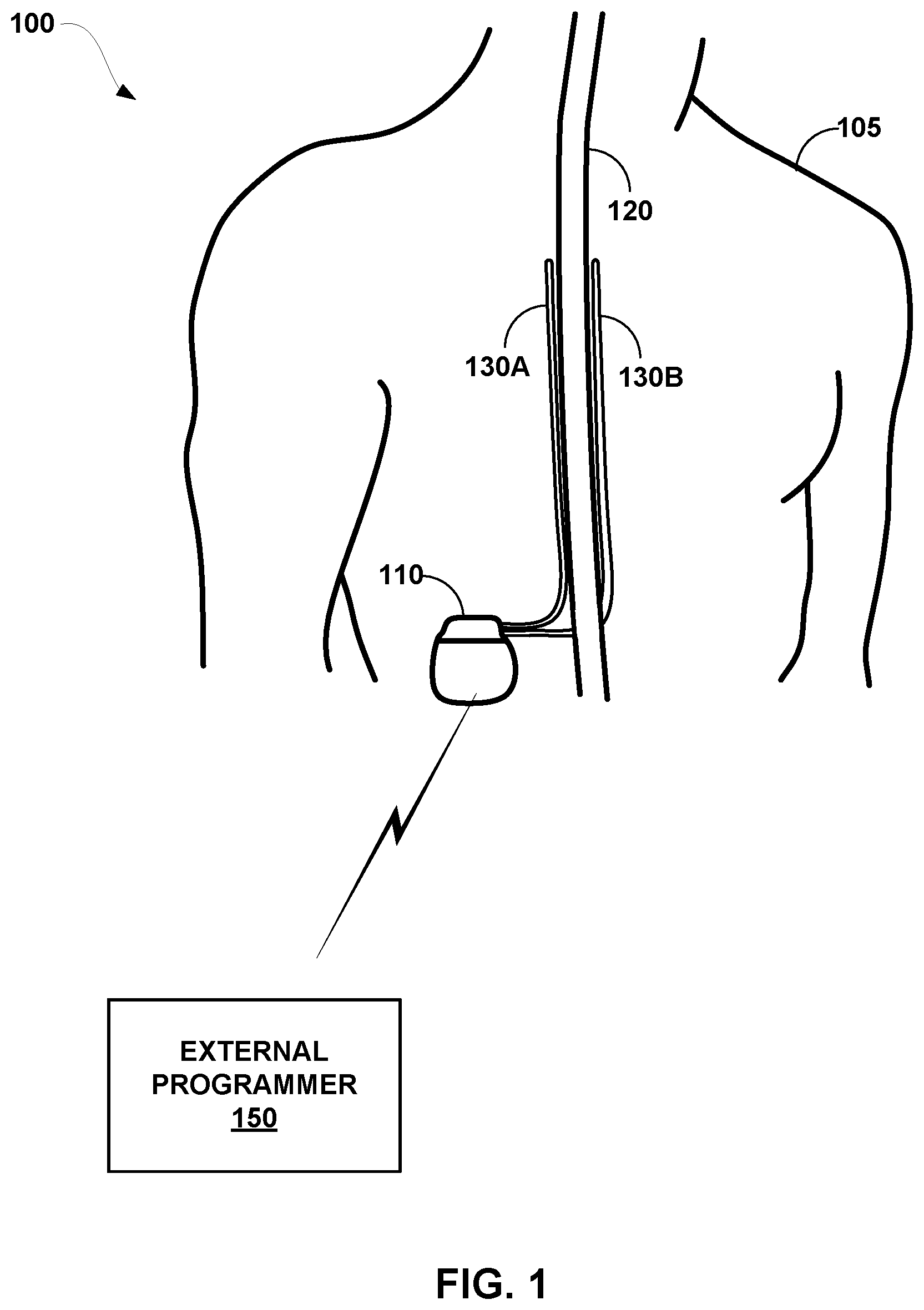 Patent US11779765 — Posture-based control of electrical stimulation therapy — Figure 1