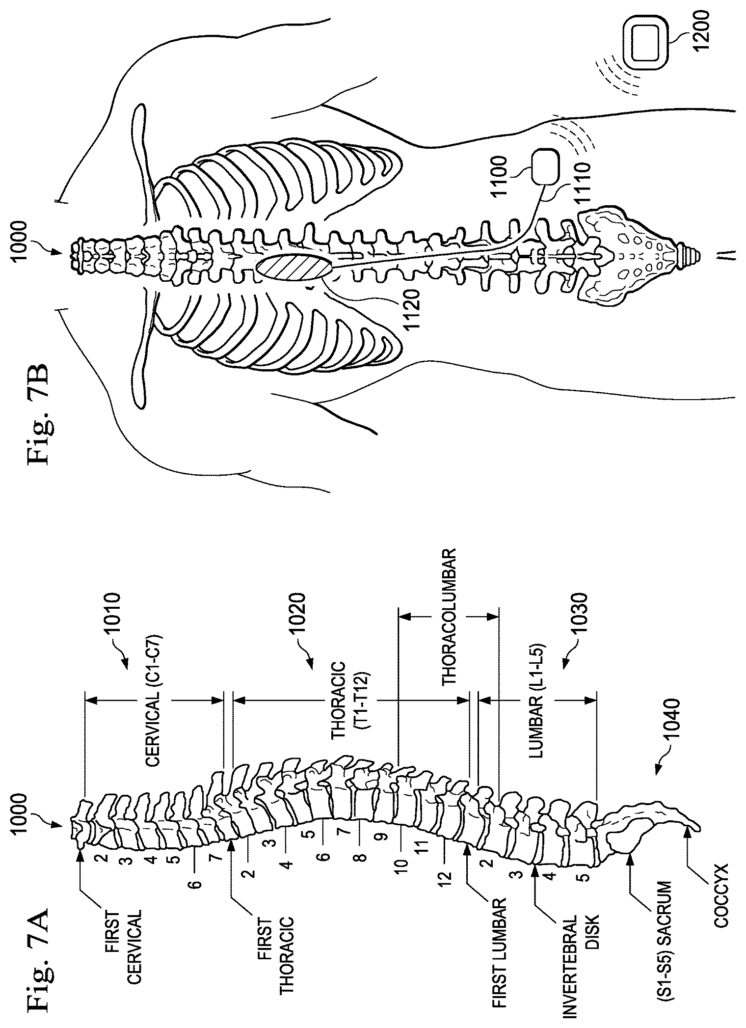 Patent US11779766 Figure 6 – Measuring load impedance with active stimulation pulses in an implanted pulse generator