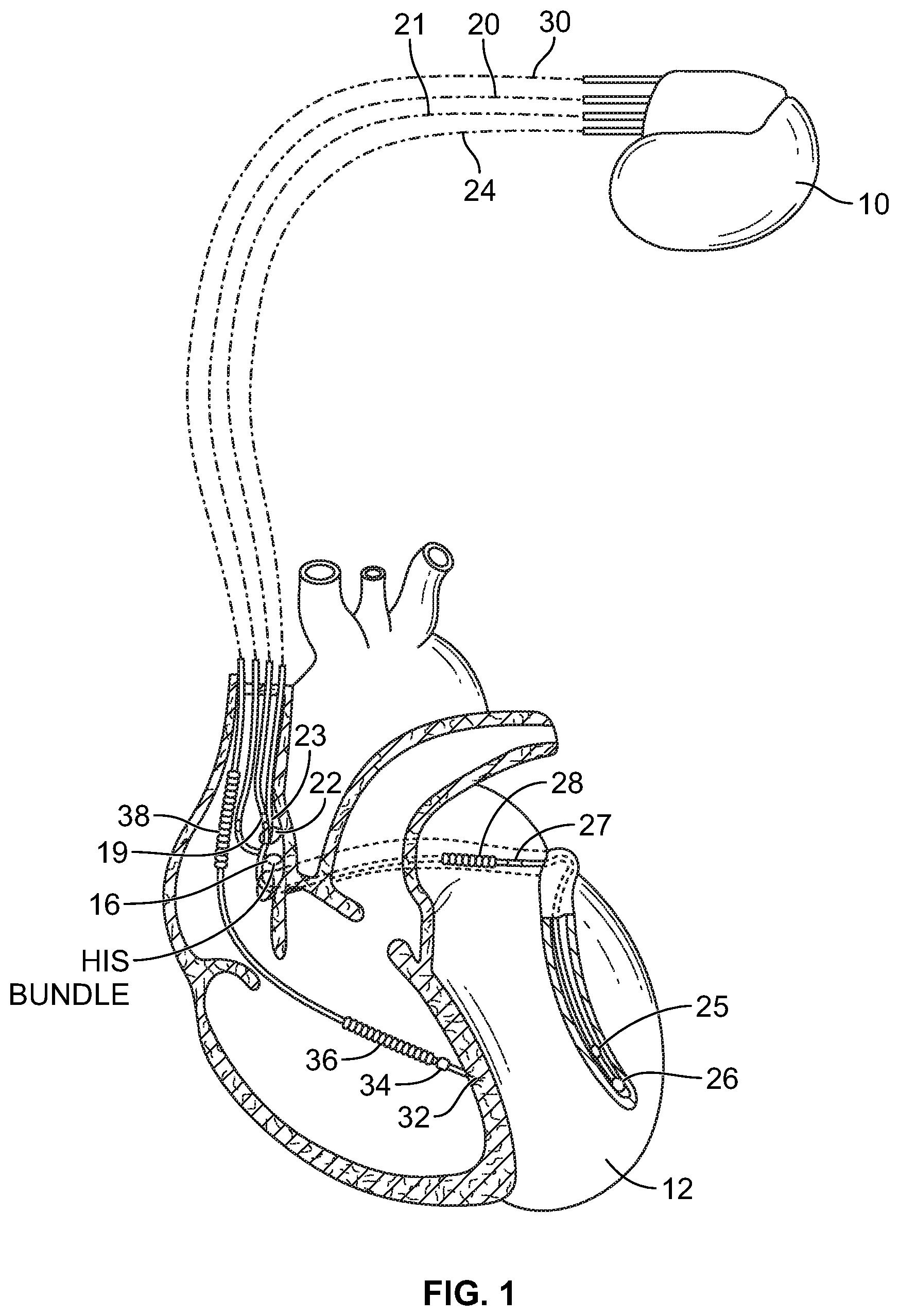 Patent US11779769 Figure 1 – Method and device for avoiding atrial activity oversensing on his sensing channel