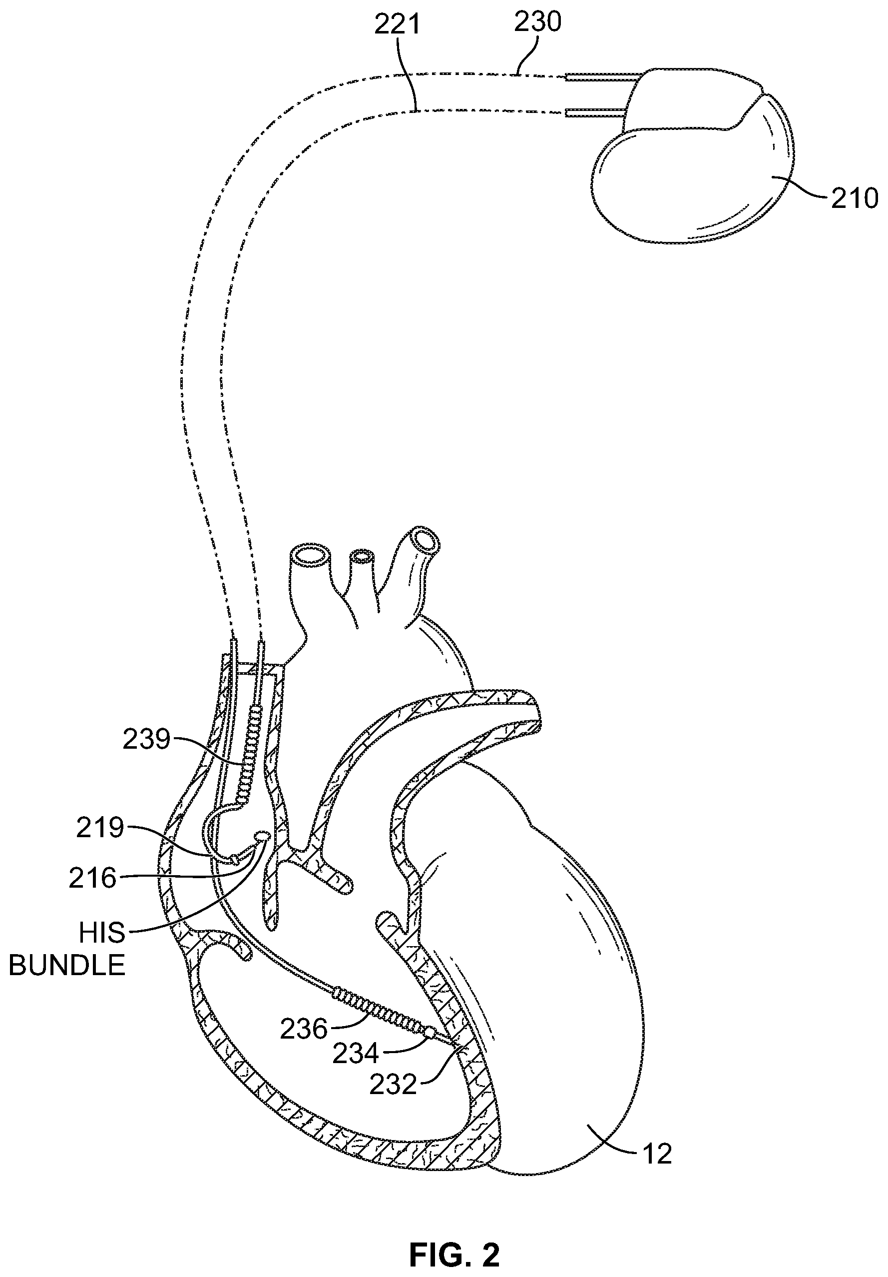 Patent US11779769 Figure 2 – Method and device for avoiding atrial activity oversensing on his sensing channel