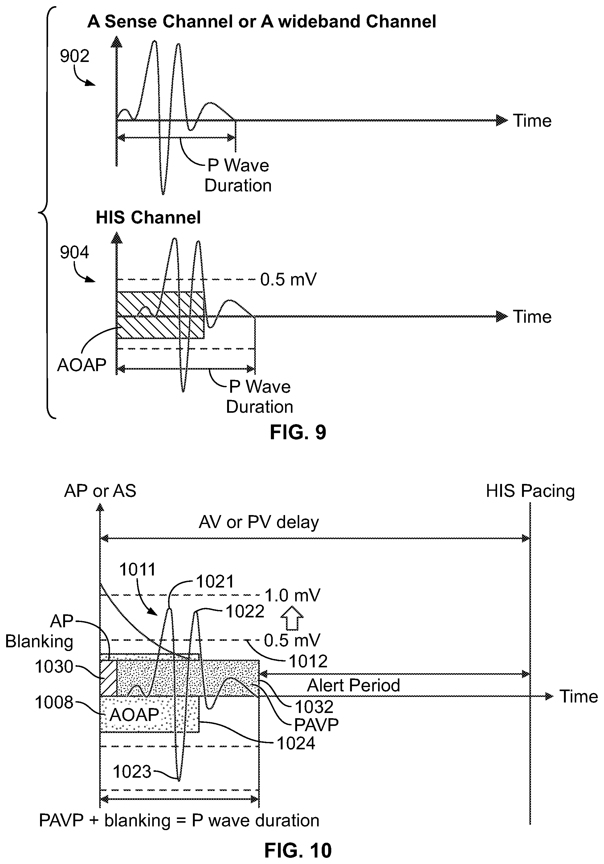Patent US11779769 Figure 11 – Method and device for avoiding atrial activity oversensing on his sensing channel