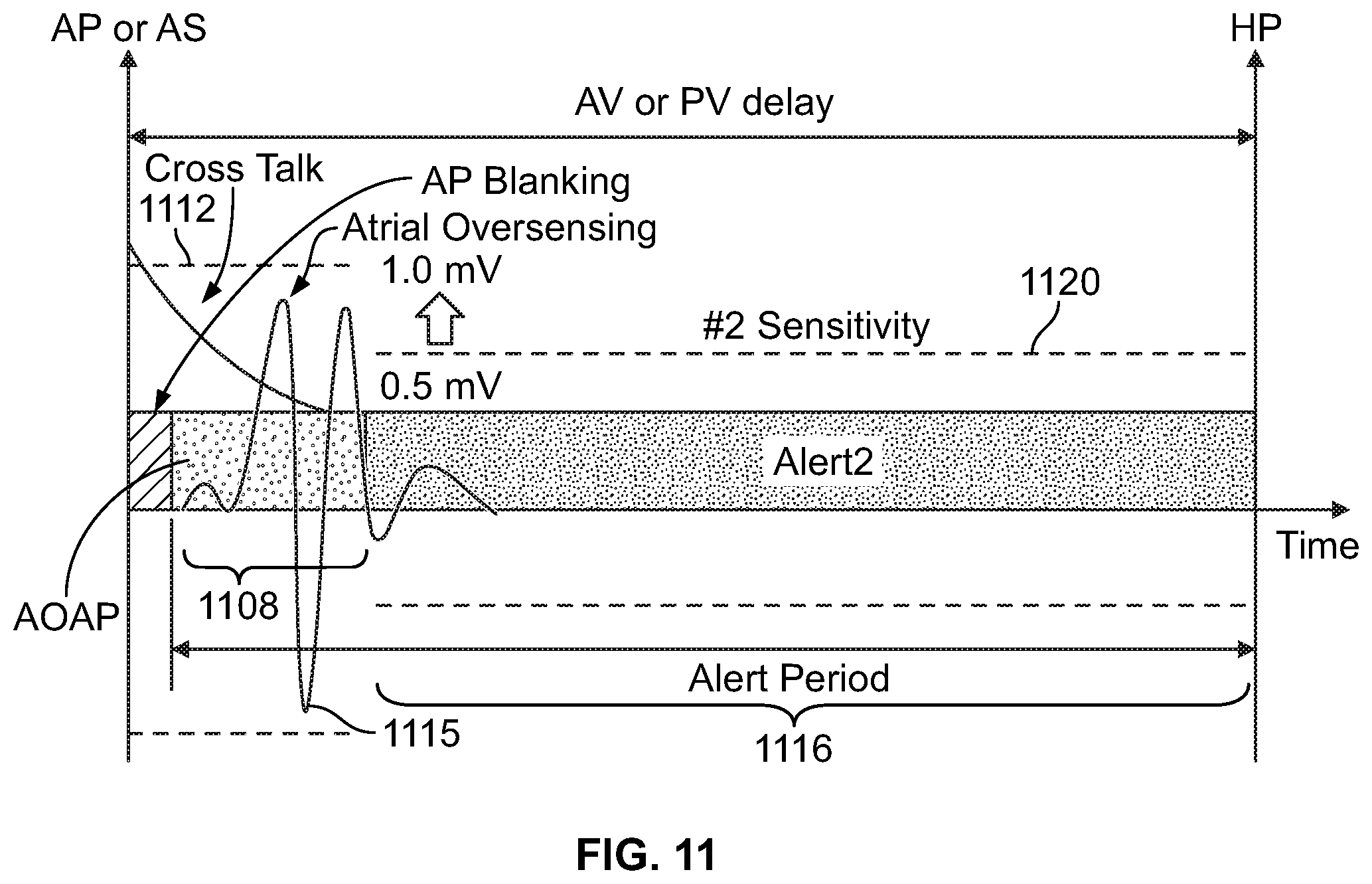 Patent US11779769 Figure 12 – Method and device for avoiding atrial activity oversensing on his sensing channel