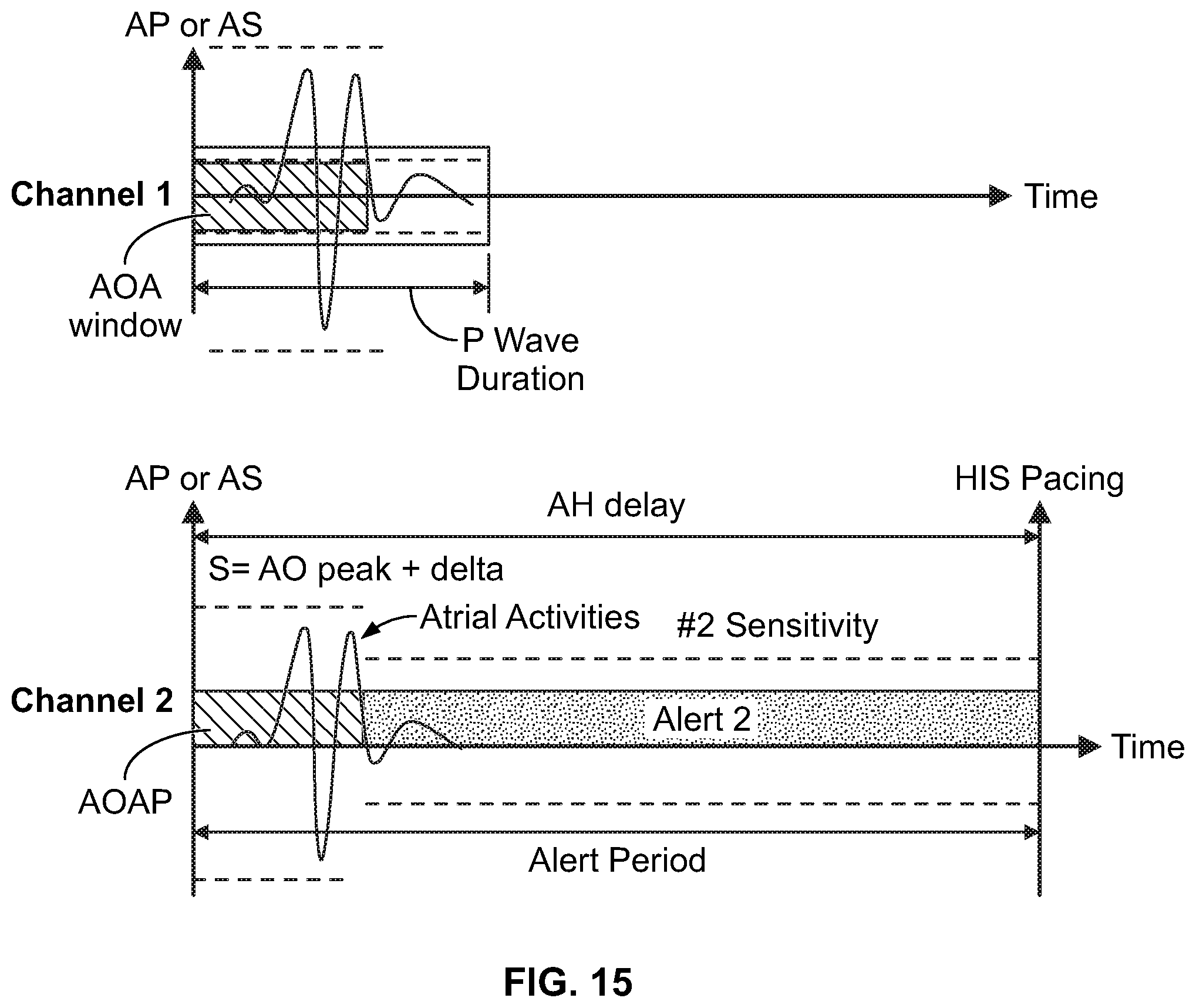 Patent US11779769 Figure 17 – Method and device for avoiding atrial activity oversensing on his sensing channel