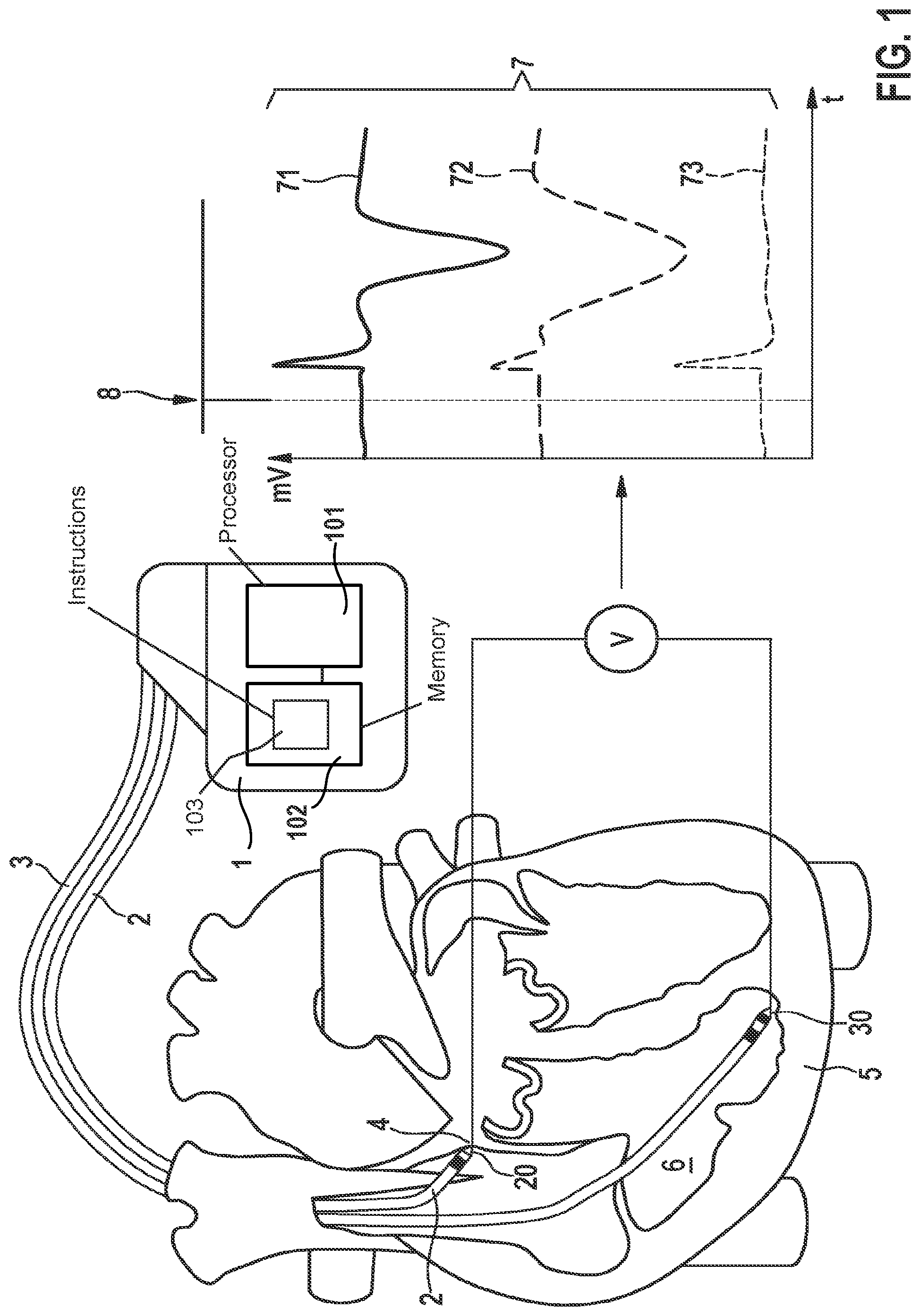 Patent US11779771 Figure 1 – Implantable medical device for stimulating a human or animal heart employing an evaluation of signals between a His electrode and a further electrode
