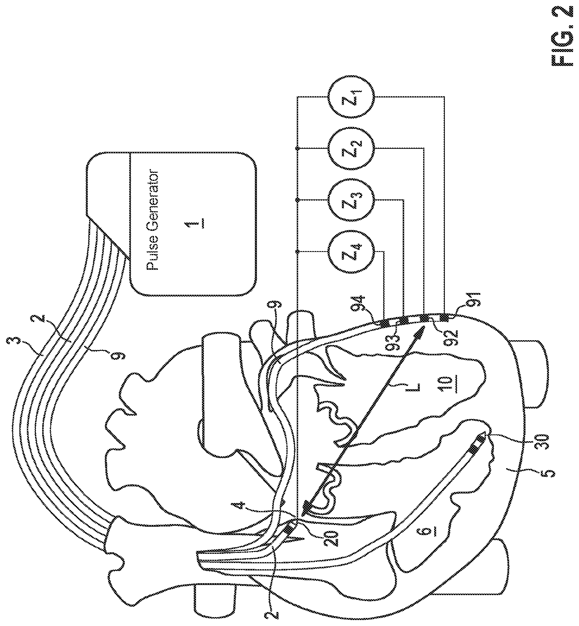 Patent US11779771 Figure 2 – Implantable medical device for stimulating a human or animal heart employing an evaluation of signals between a His electrode and a further electrode