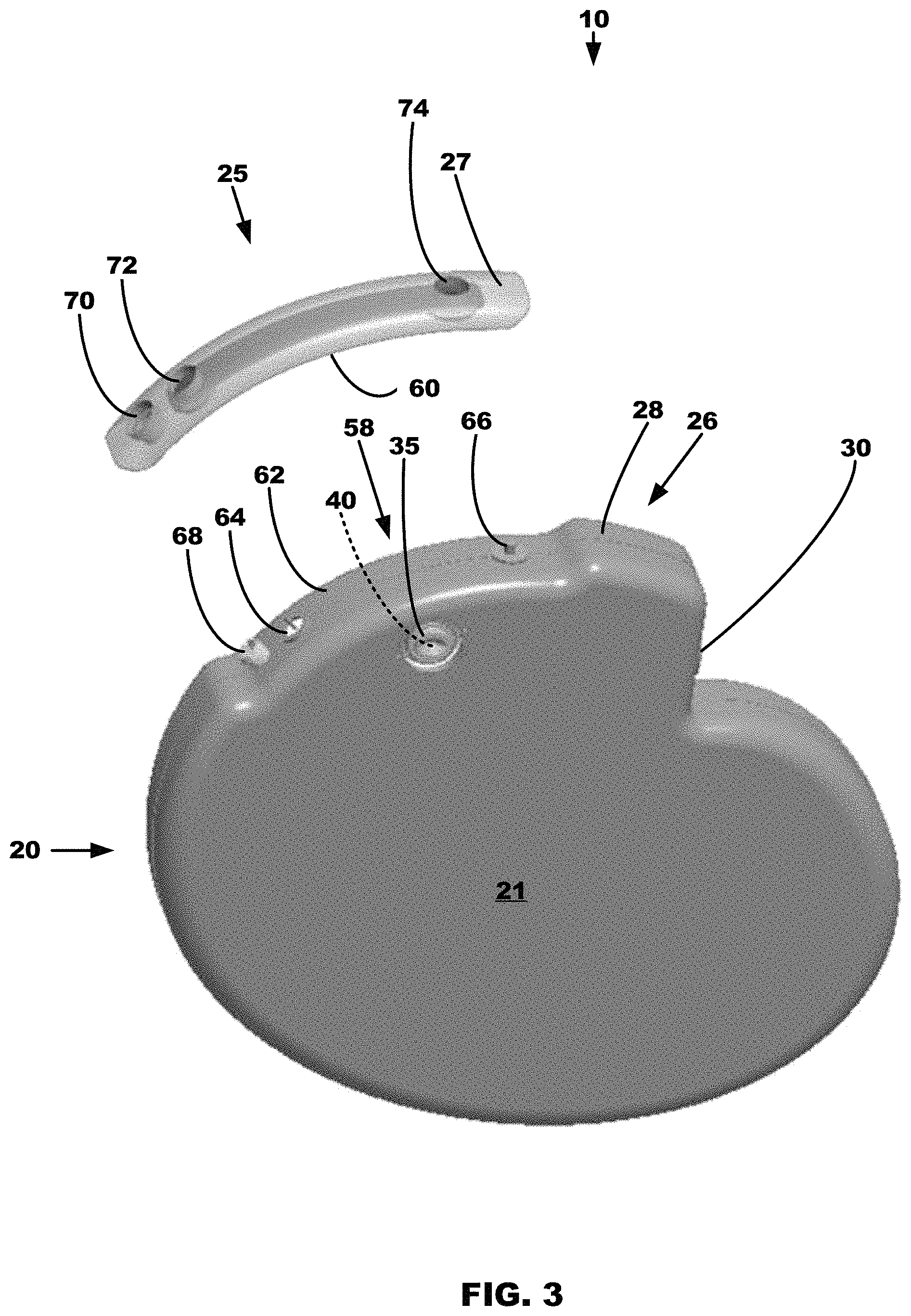 Patent US11779772 Figure 2 – All metal enclosed implantable medical device with external BLE antenna for RF telemetry