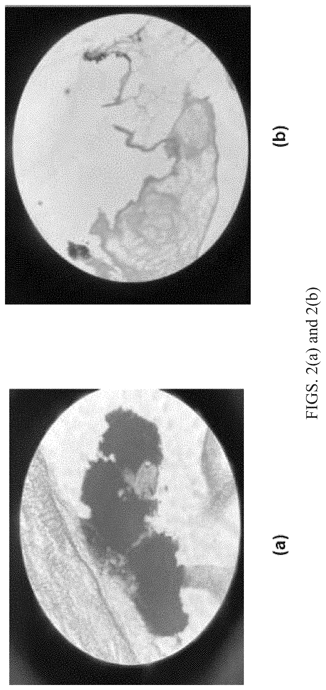 Patent US11779776 Figure 2 – Systems and methods for decalcifying cardiac valves and vessels