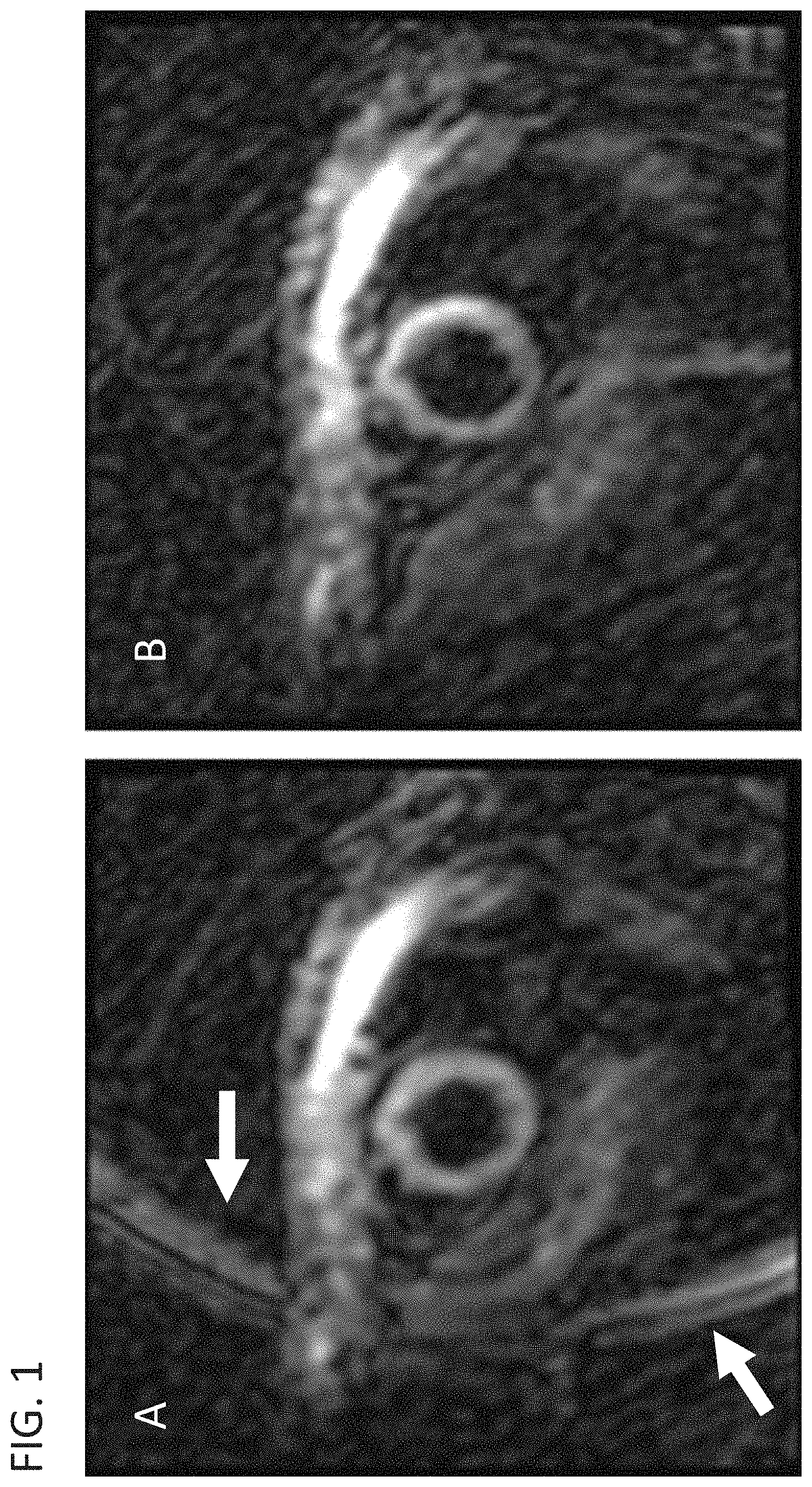 Patent US11782114 Figure 1 – Reducing artifact generation echo in stimulated-echo-based strain imaging