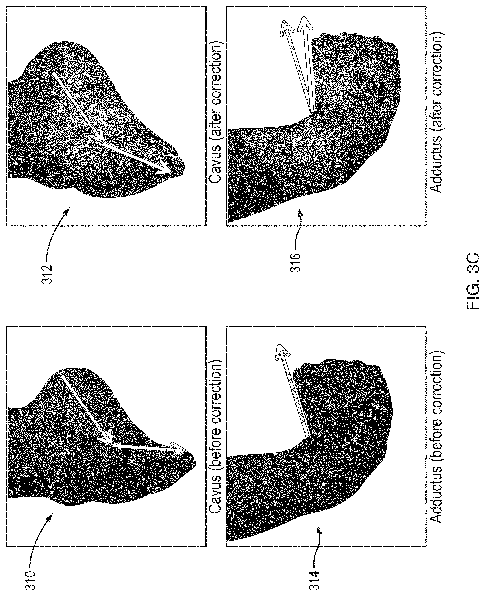 Patent US11783102 Figure 6 – Predictive modeling platform for serial casting to correct orthopedic deformities