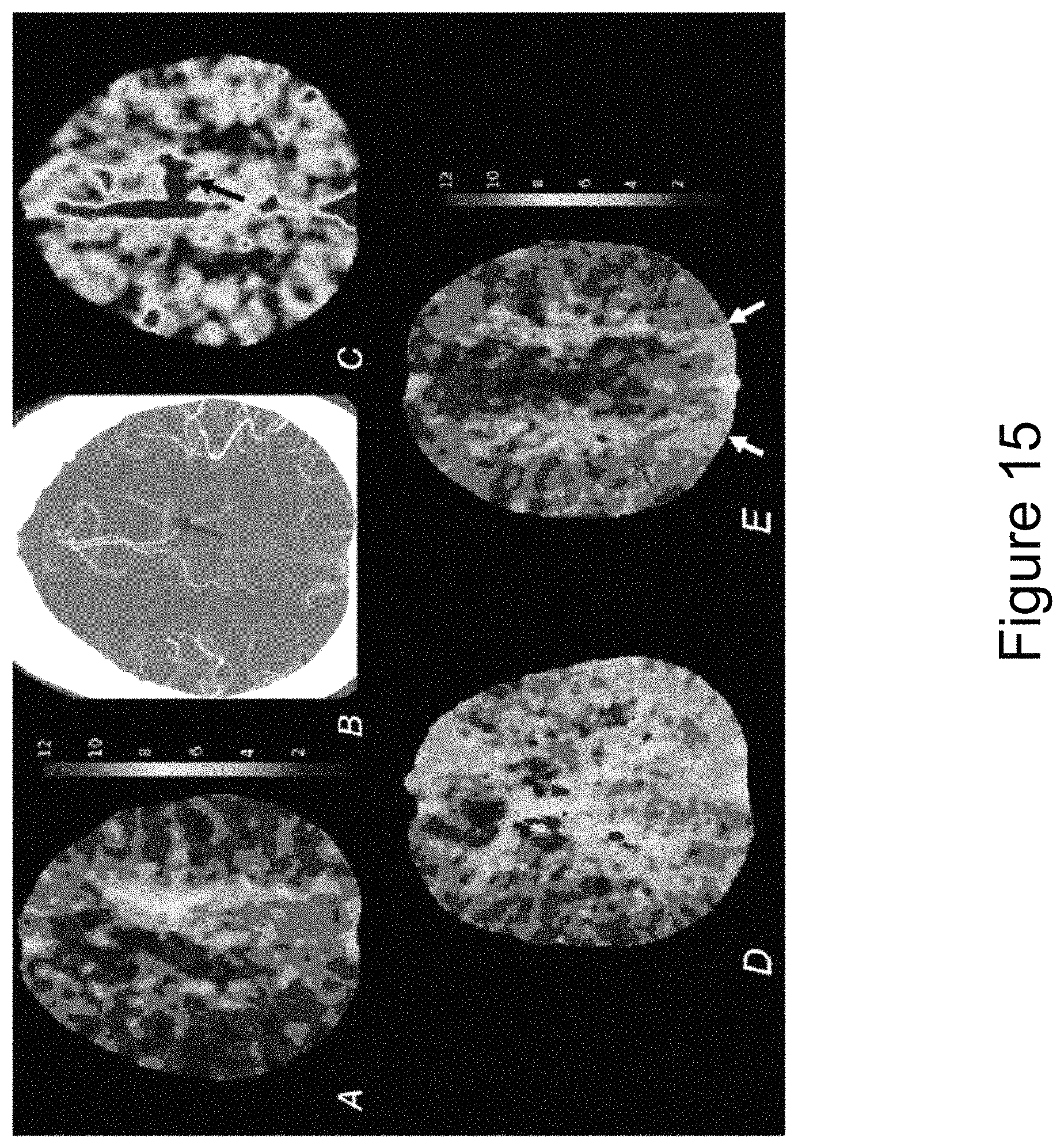 Patent US11783481 Figure 15 – Identifying vessel occlusions using spatial patterns