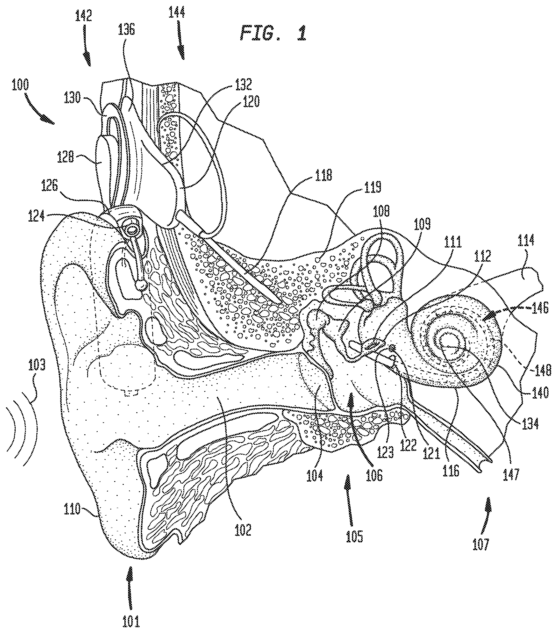 Patent US11783845 Figure 1 – Sound processing with increased noise suppression