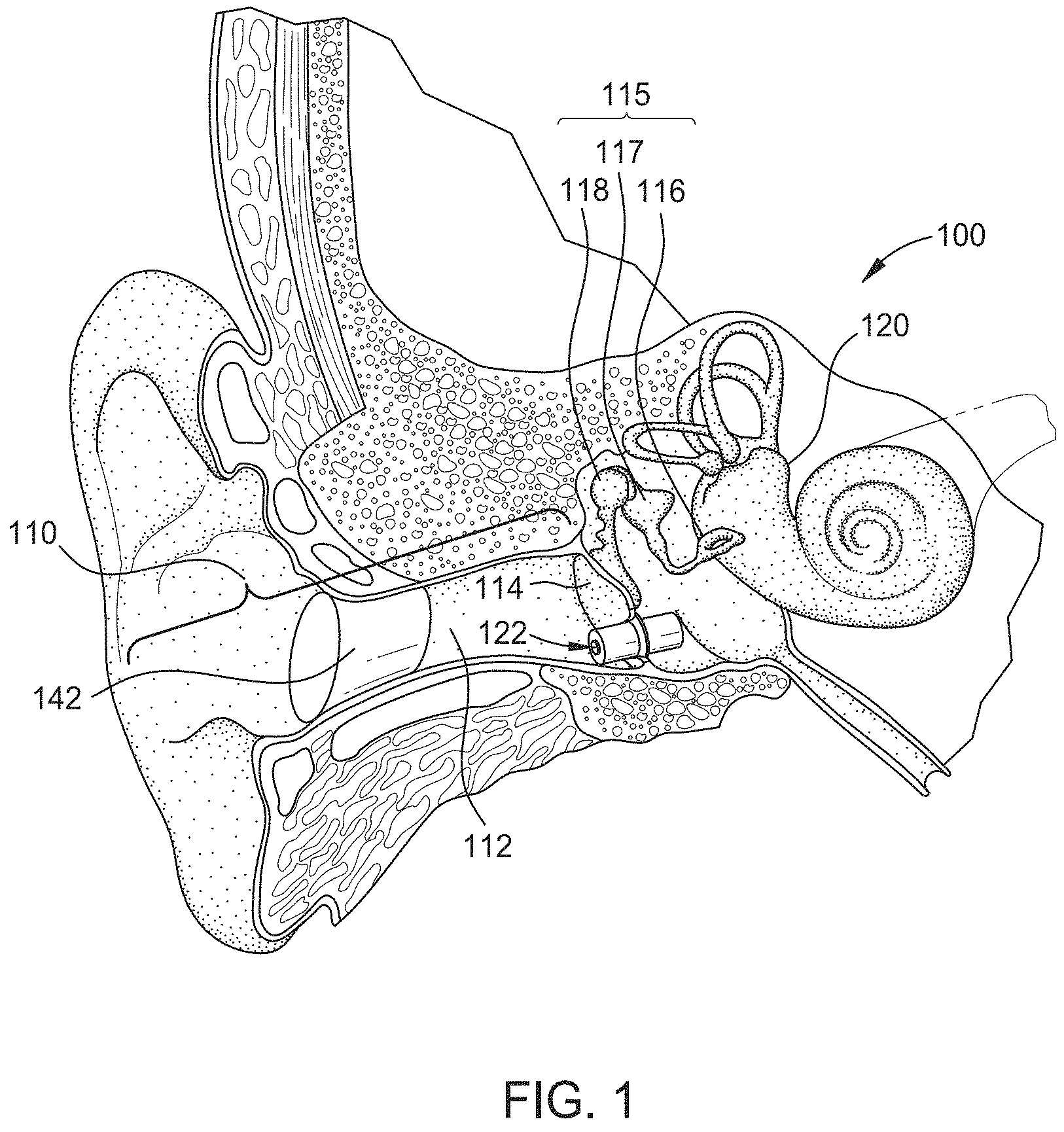 Patent US11785401 Figure 1 – Hearing aid implant recharging system