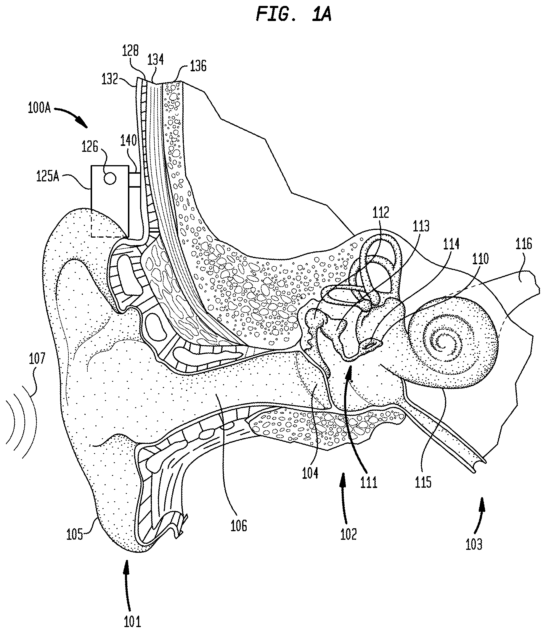 Patent US11785402 — Environmental classification controlled output level in bone conduction devices — Figure 1