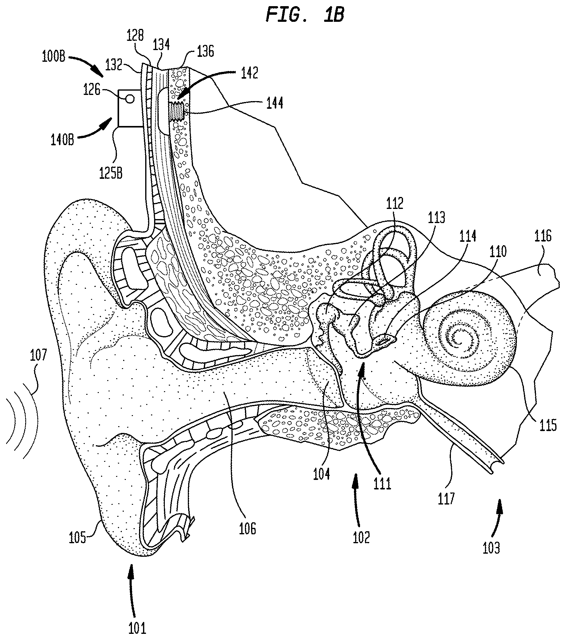 Patent US11785402 Figure 2 – Environmental classification controlled output level in bone conduction devices